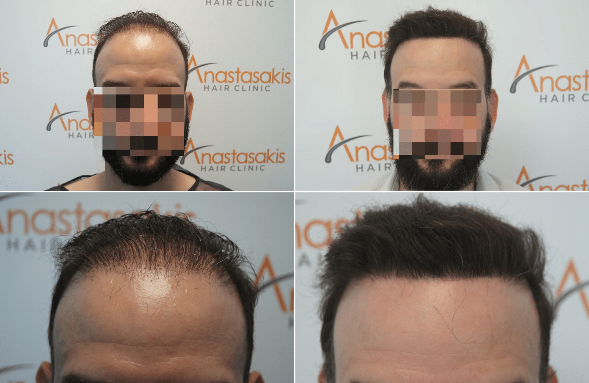 https://www.anastasakishairclinic.gr/portfolio/apotelesma-metamosxefsis-mallion-anastasakis-hair-clinic-354/