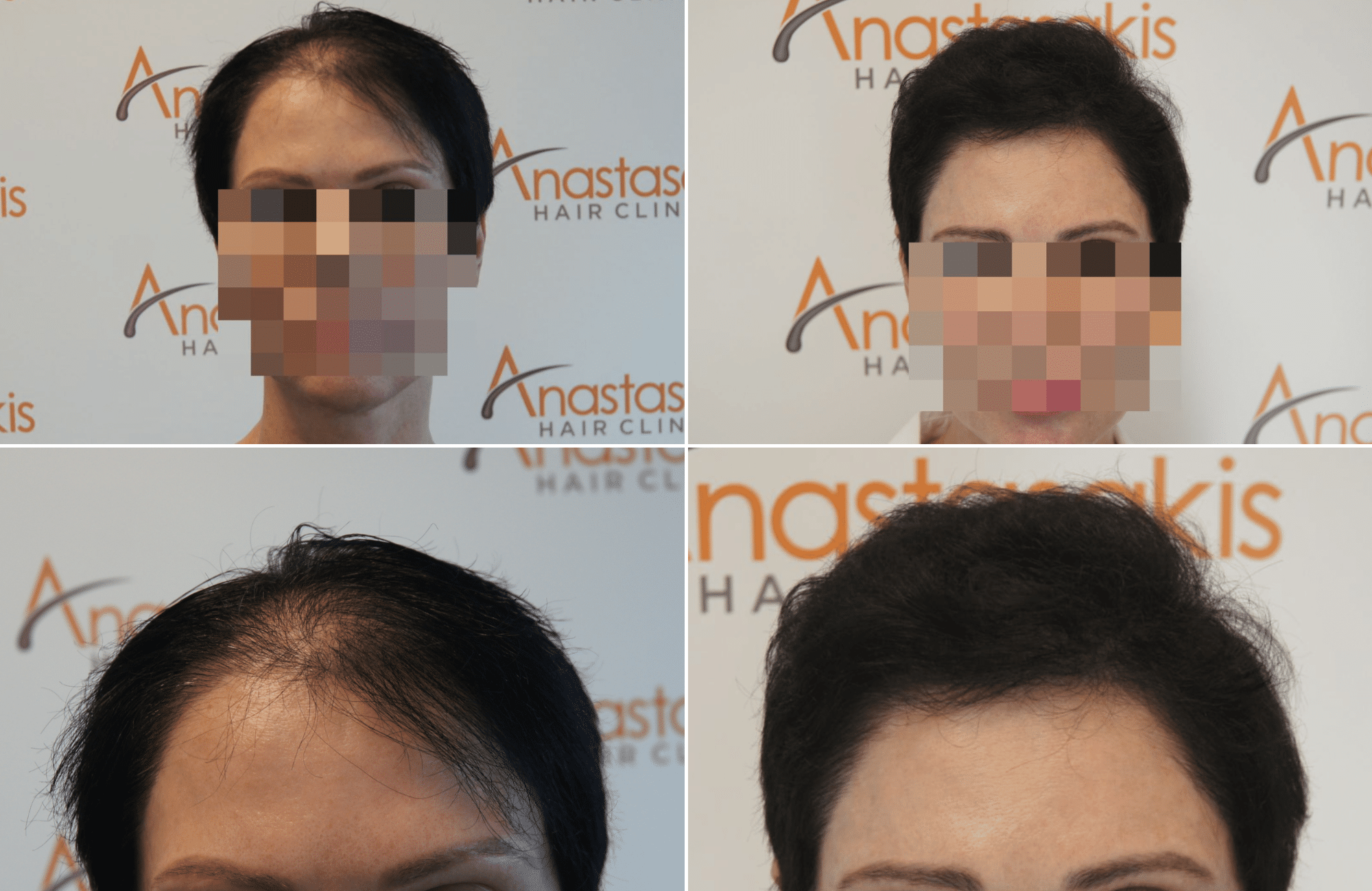 https://www.anastasakishairclinic.gr/portfolio/apotelesma-metamosxefsis-mallion-anastasakis-hair-clinic-362/