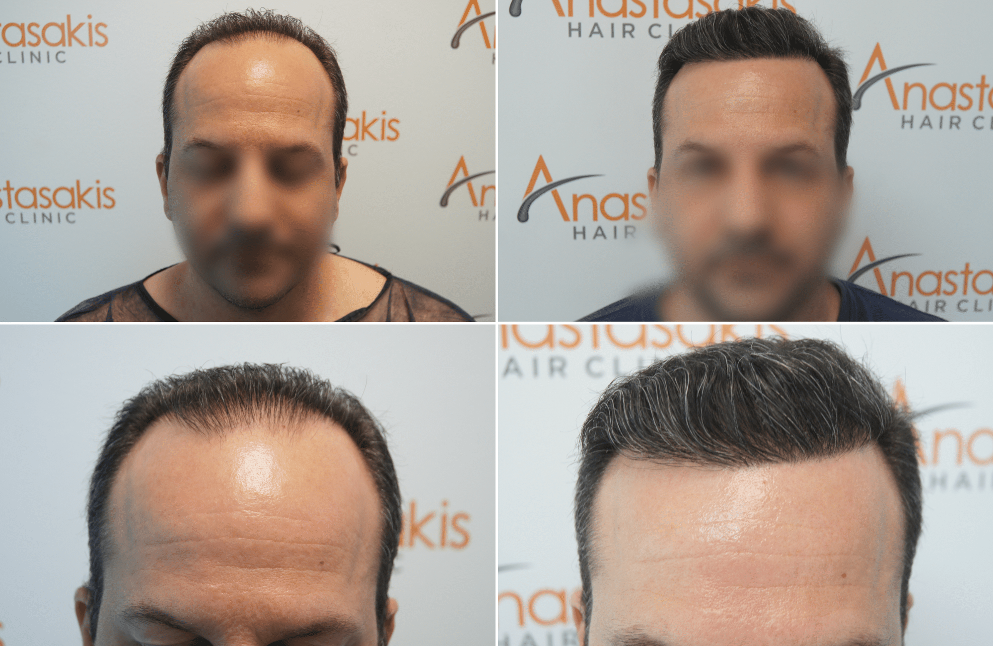 https://www.anastasakishairclinic.gr/portfolio/apotelesma-metamosxefsis-mallion-anastasakis-hair-clinic-355/