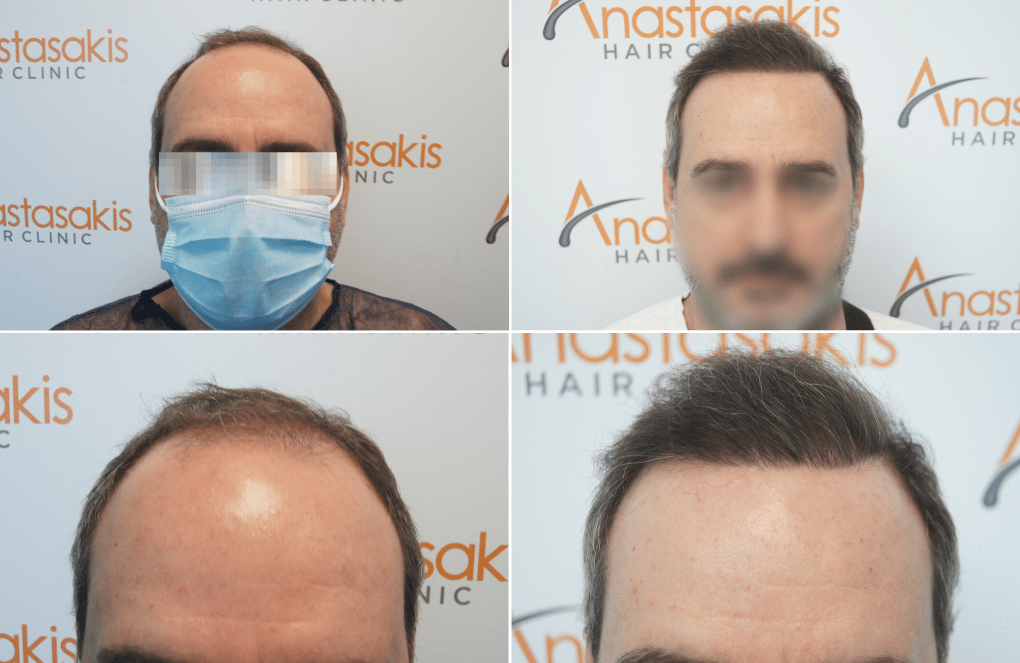 https://www.anastasakishairclinic.gr/portfolio/apotelesma-metamosxefsis-mallion-anastasakis-hair-clinic-357/