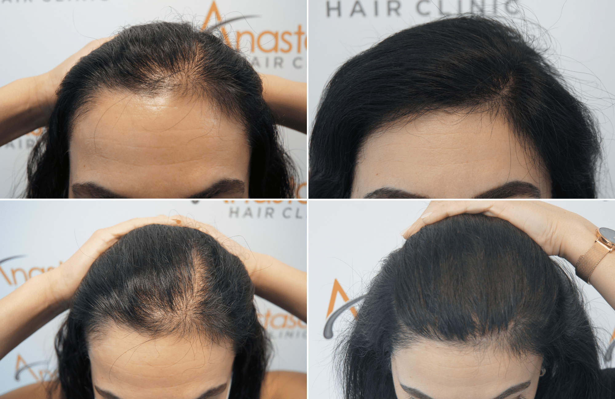https://www.anastasakishairclinic.gr/portfolio/apotelesma-metamosxefsis-mallion-anastasakis-hair-clinic-361/