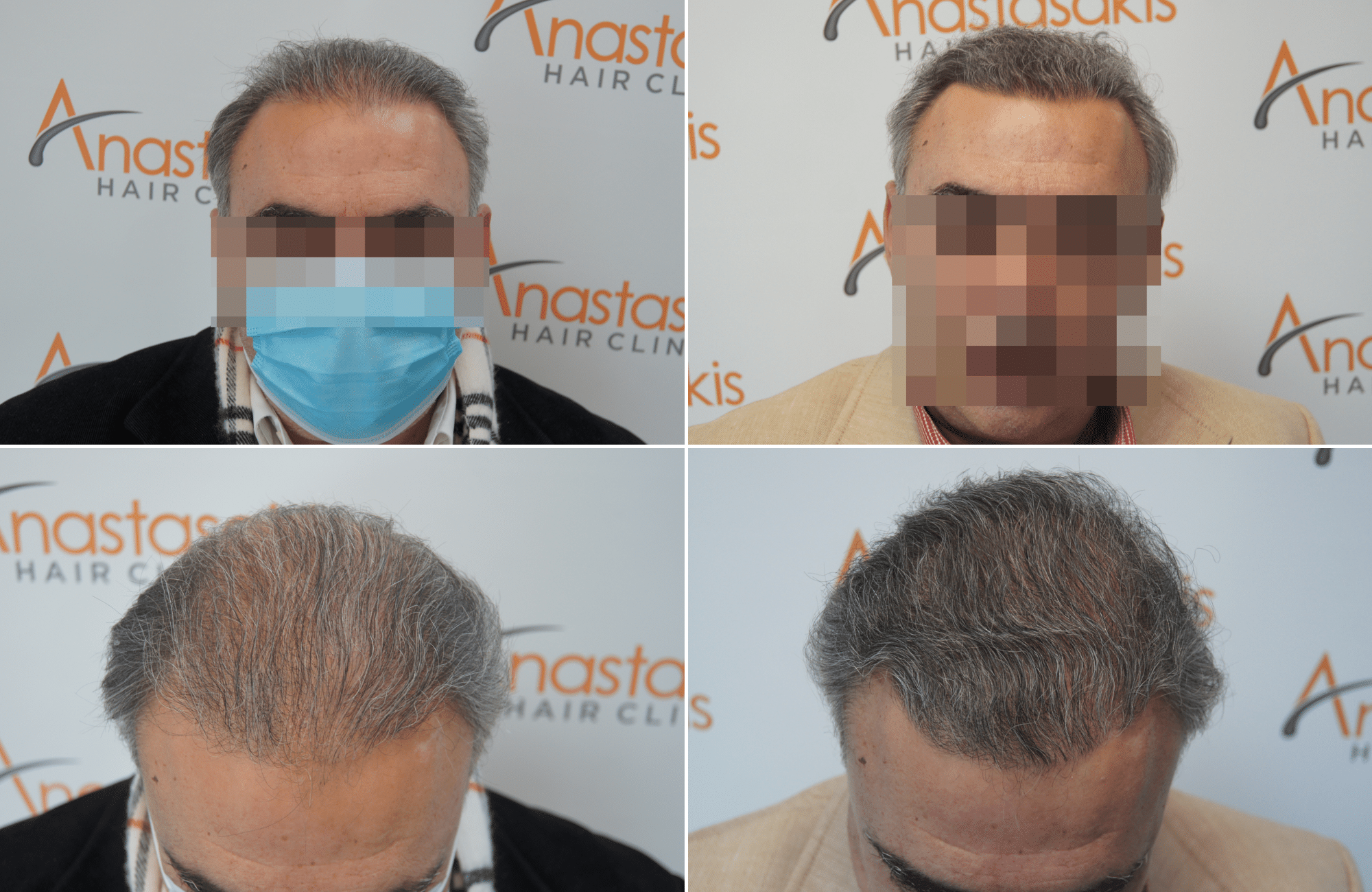 https://www.anastasakishairclinic.gr/portfolio/apotelesma-metamosxefsis-mallion-anastasakis-hair-clinic-384/
