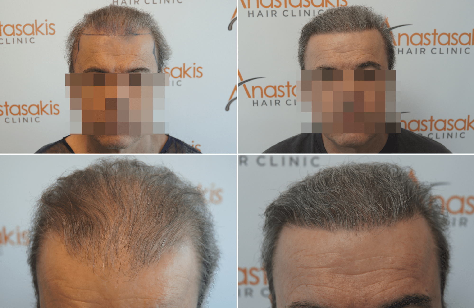 https://www.anastasakishairclinic.gr/portfolio/apotelesma-metamosxefsis-mallion-anastasakis-hair-clinic-401/