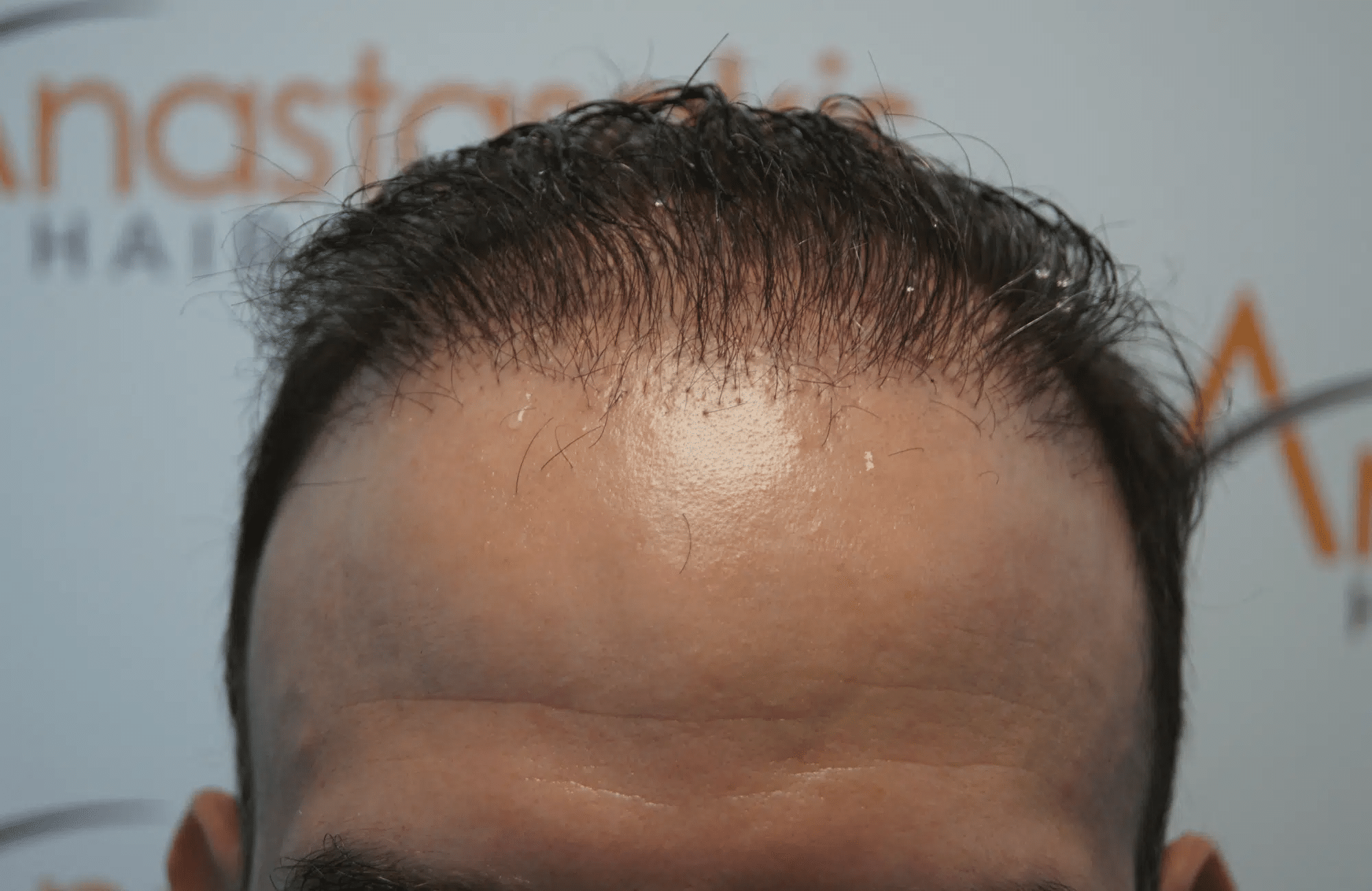 Αποτυχημένη μεταμόσχευση μαλλιών - εικόνα