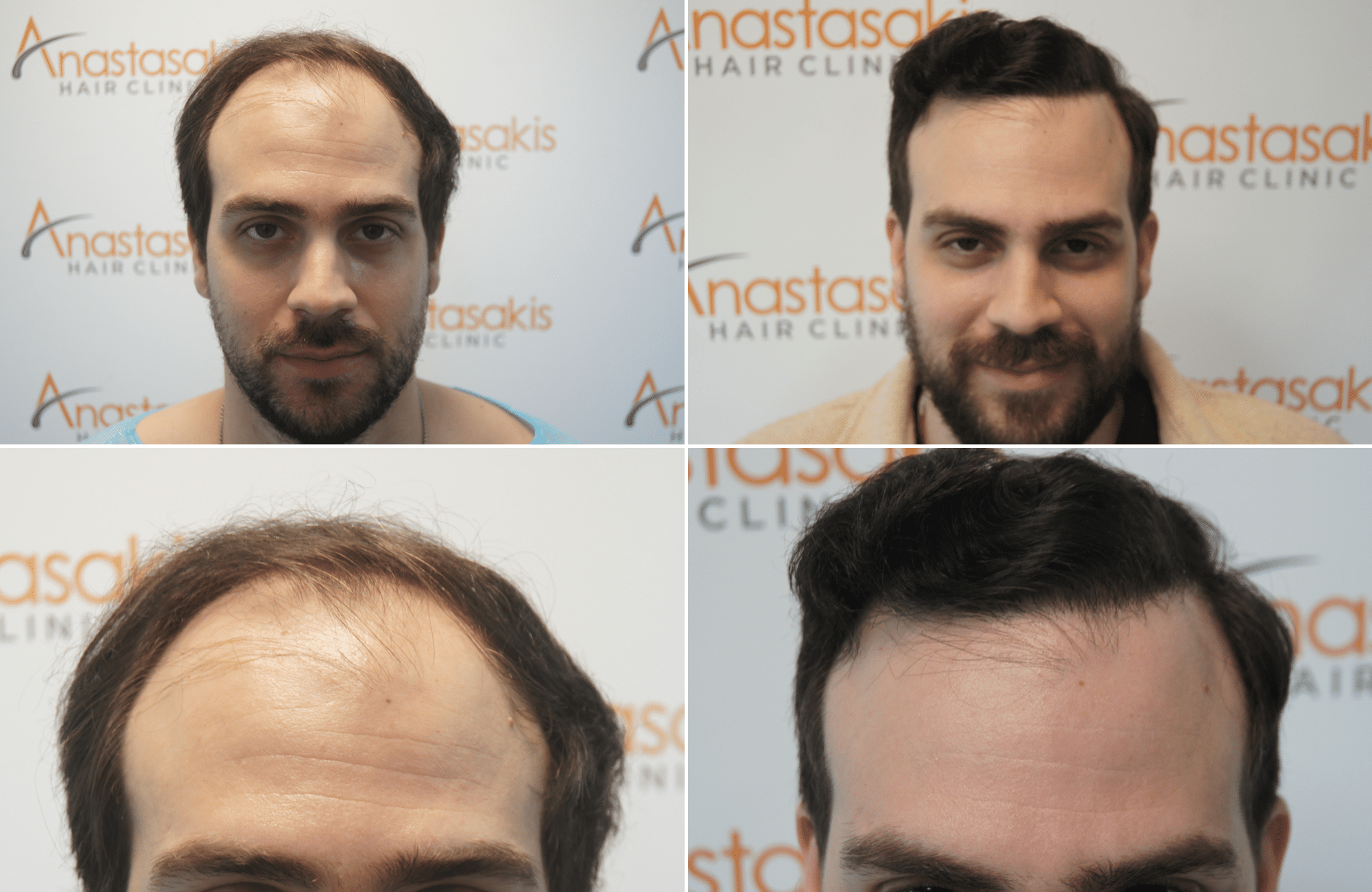 https://www.anastasakishairclinic.gr/portfolio/apotelesma-metamosxefsis-mallion-anastasakis-hair-clinic-358/