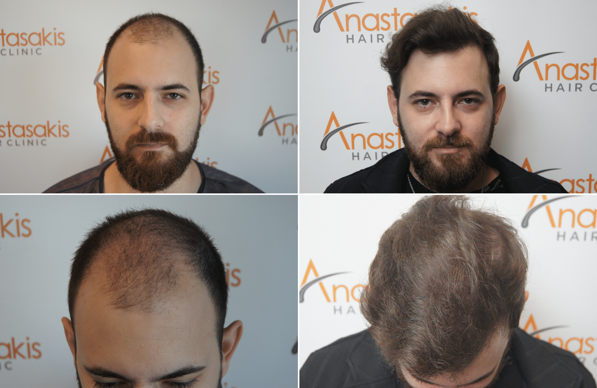 https://www.anastasakishairclinic.gr/portfolio/apotelesma-metamosxefsis-mallion-anastasakis-hair-clinic-359/