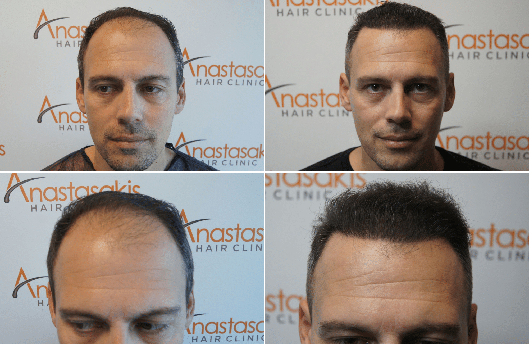 https://www.anastasakishairclinic.gr/portfolio/apotelesma-metamosxefsis-mallion-anastasakis-hair-clinic-360/