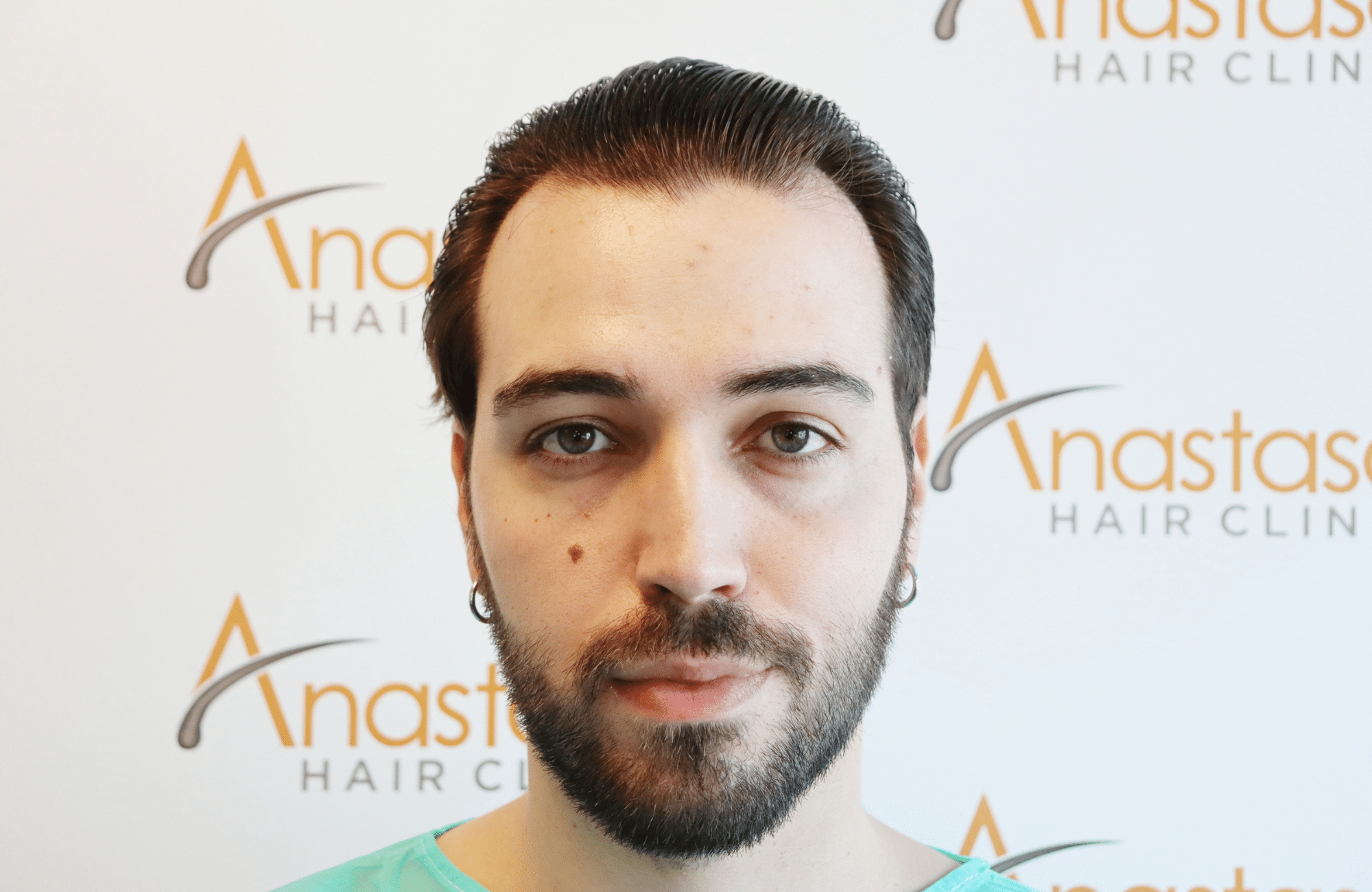 hair transplant result