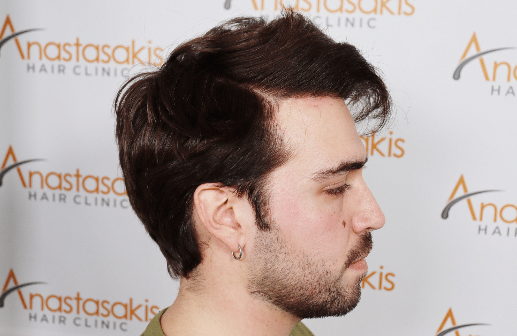 hair transplant result