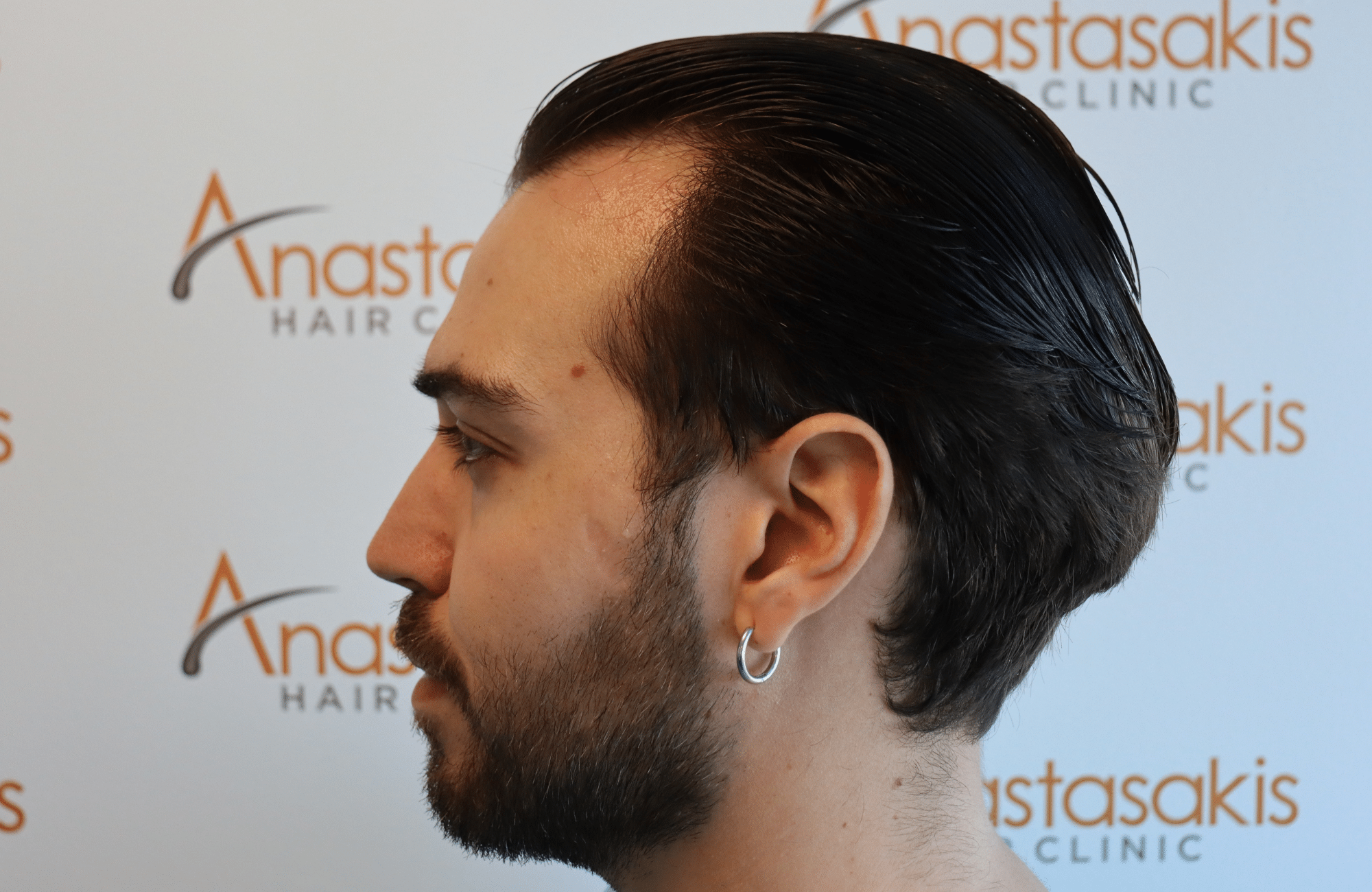 hair transplant result