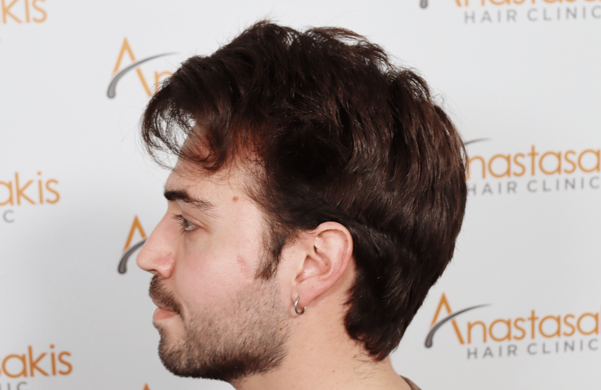 hair transplant result