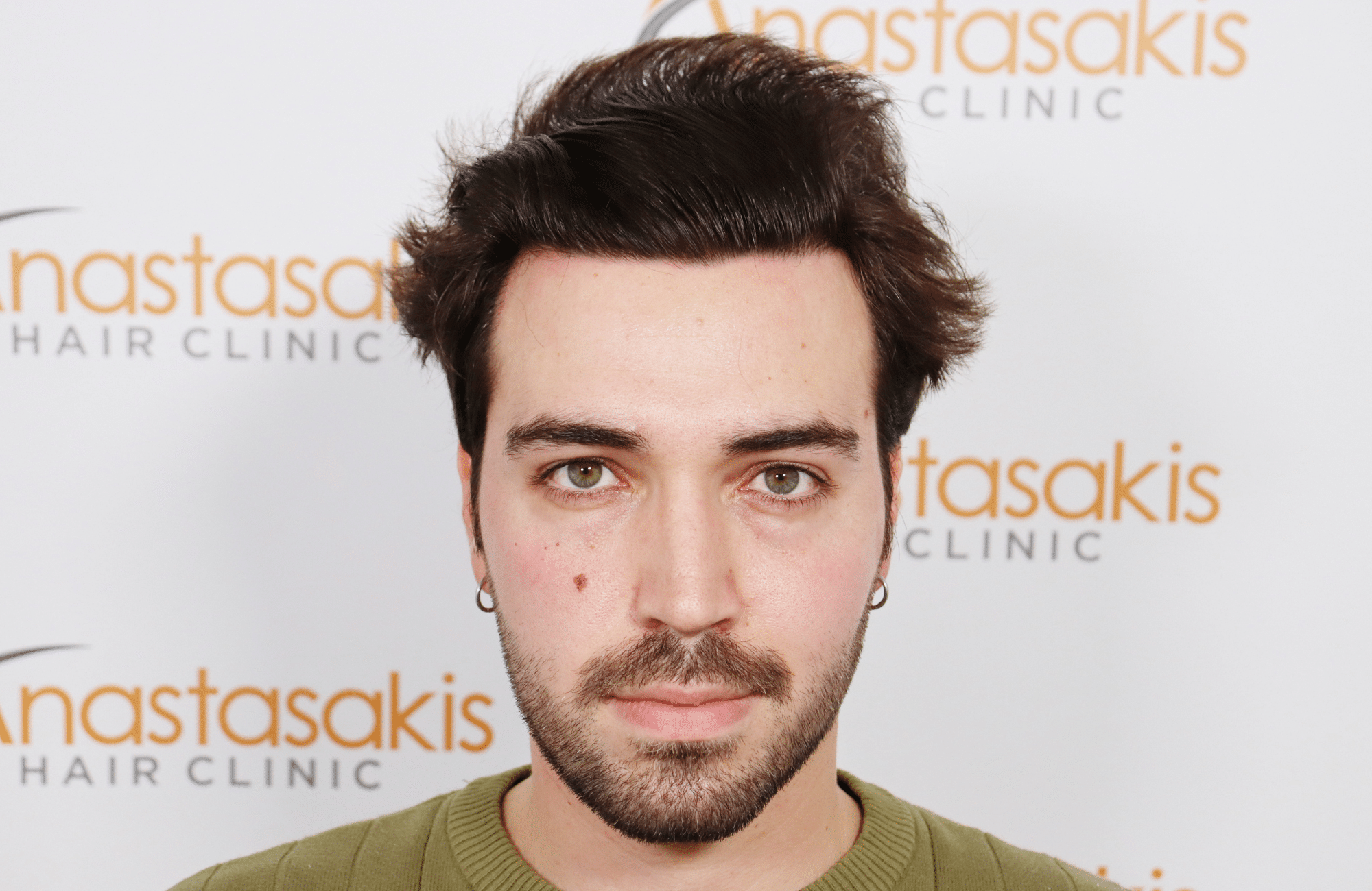 hair transplant result