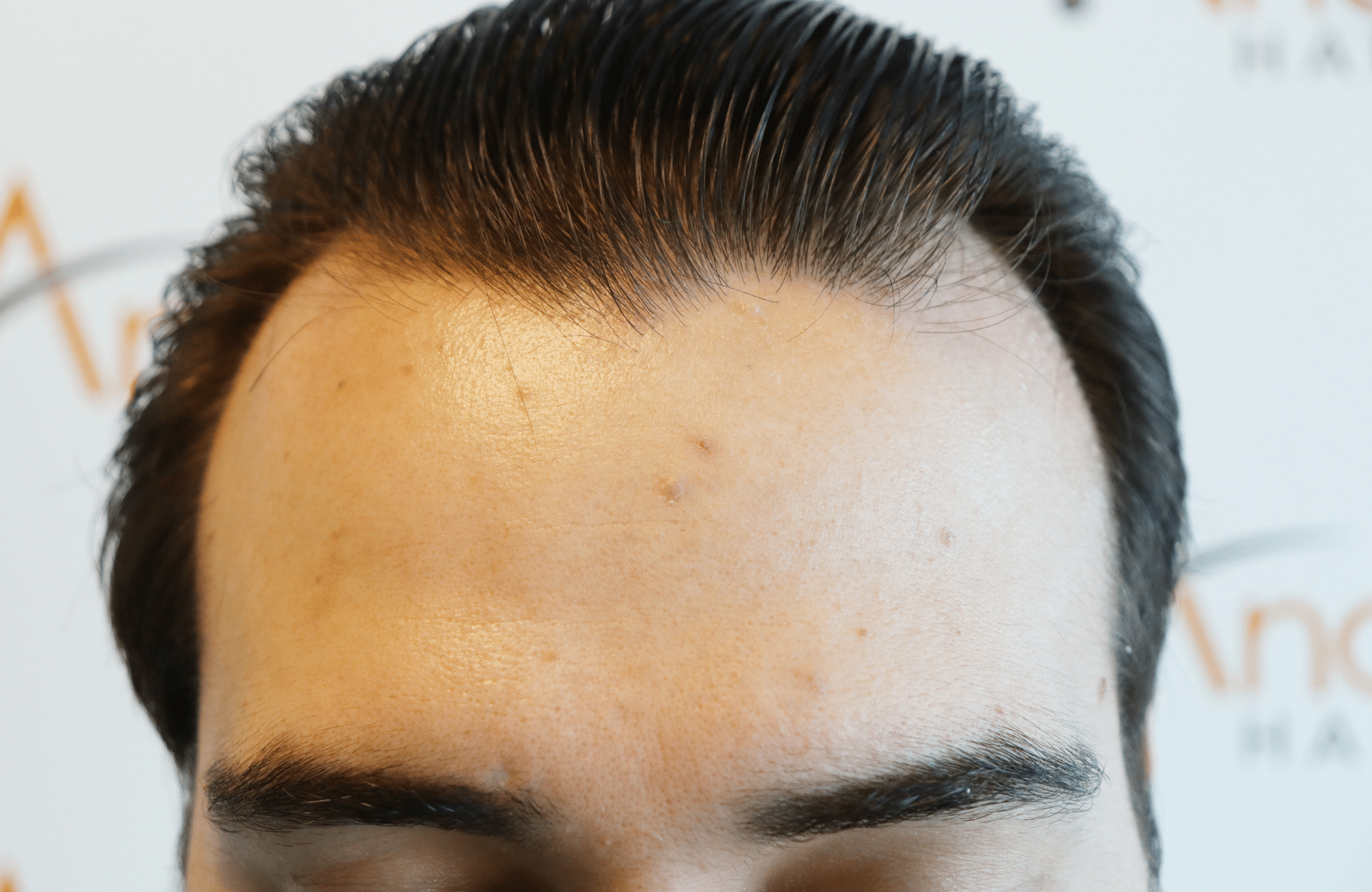 hair transplant result