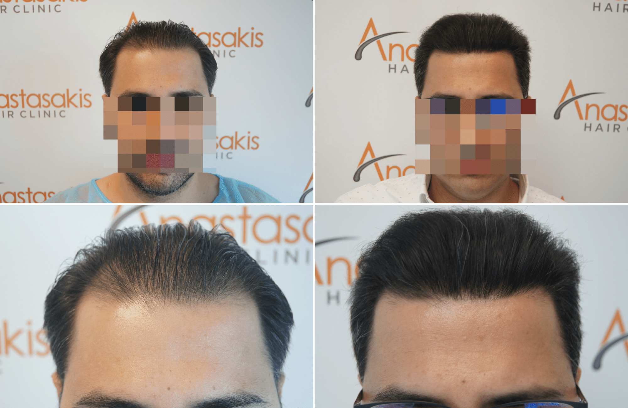 https://www.anastasakishairclinic.gr/portfolio/apotelesma-metamosxefsis-mallion-anastasakis-hair-clinic-363/