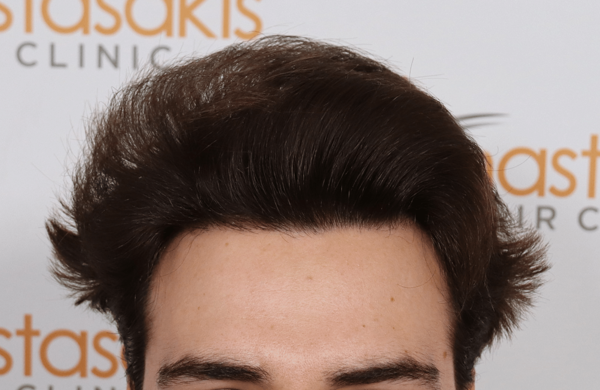 hair transplant result