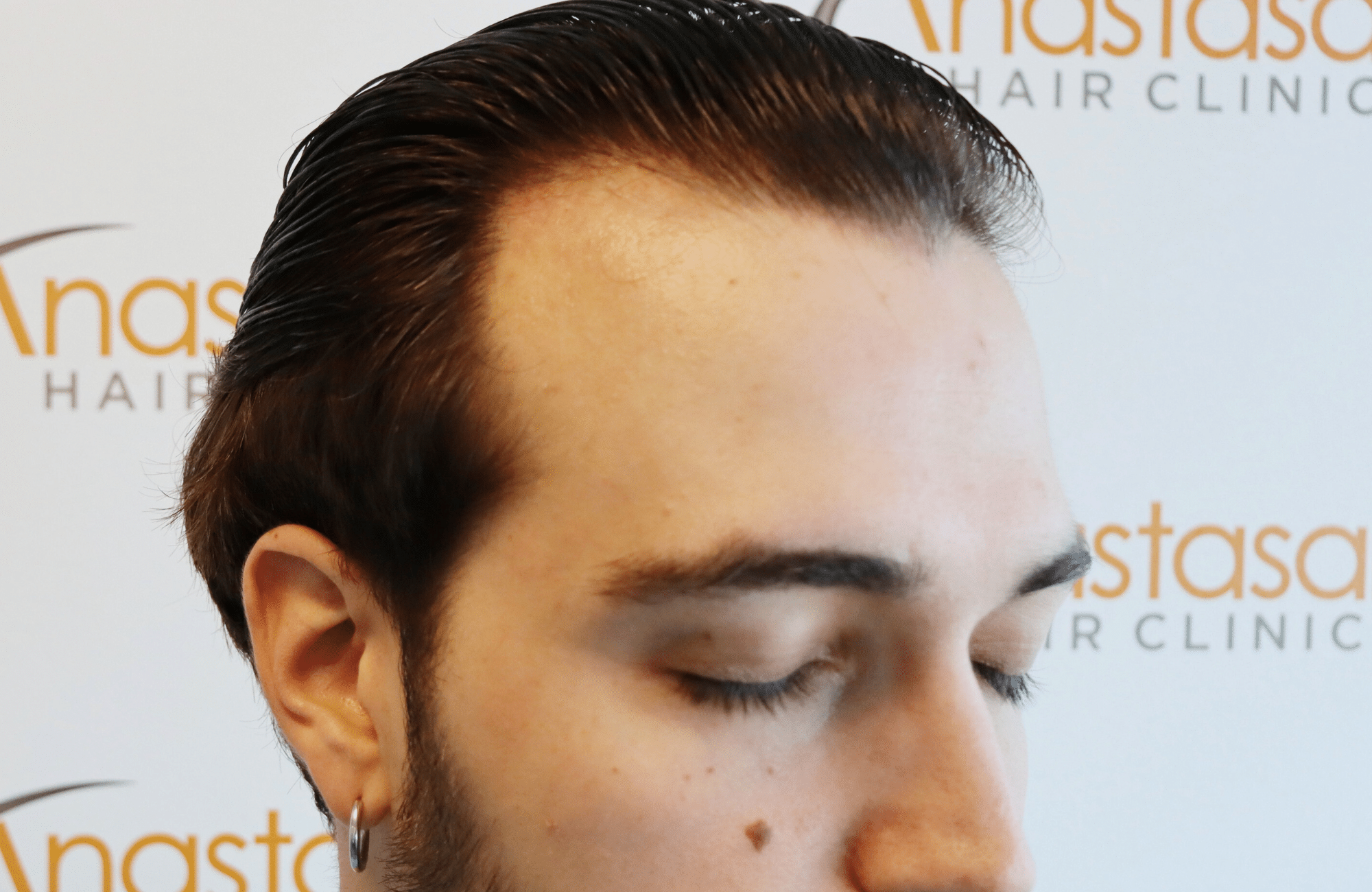 hair transplant result