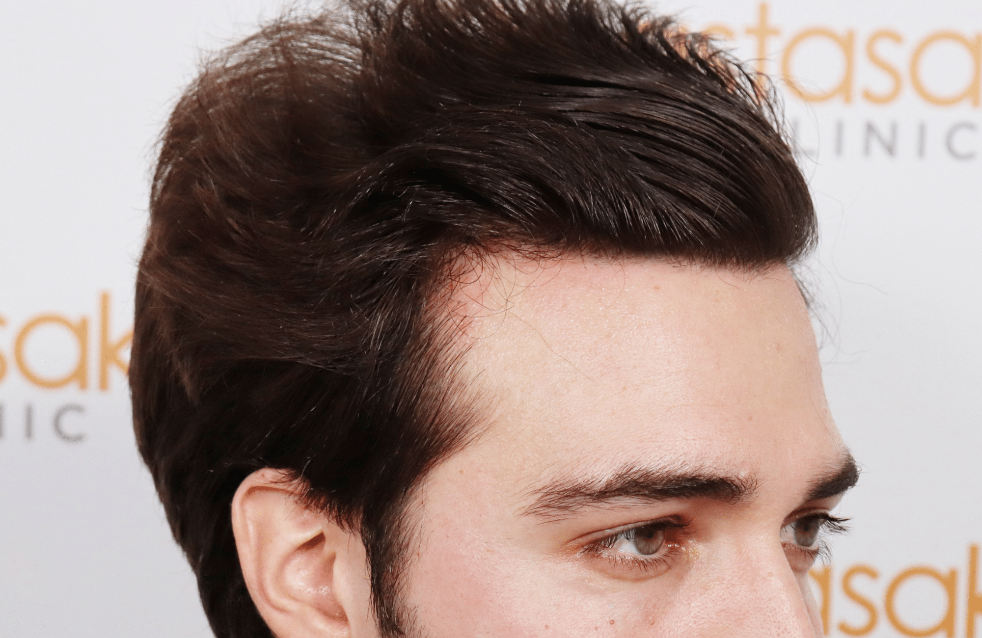 hair transplant result