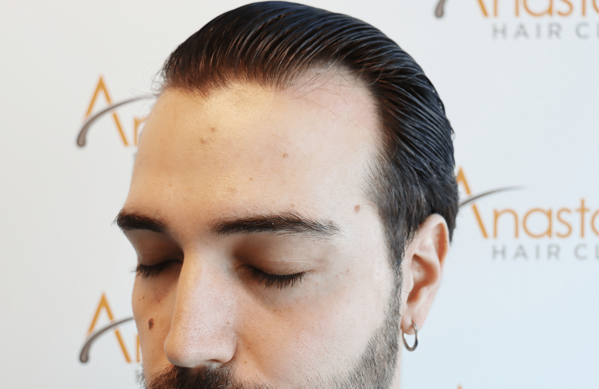 hair transplant result