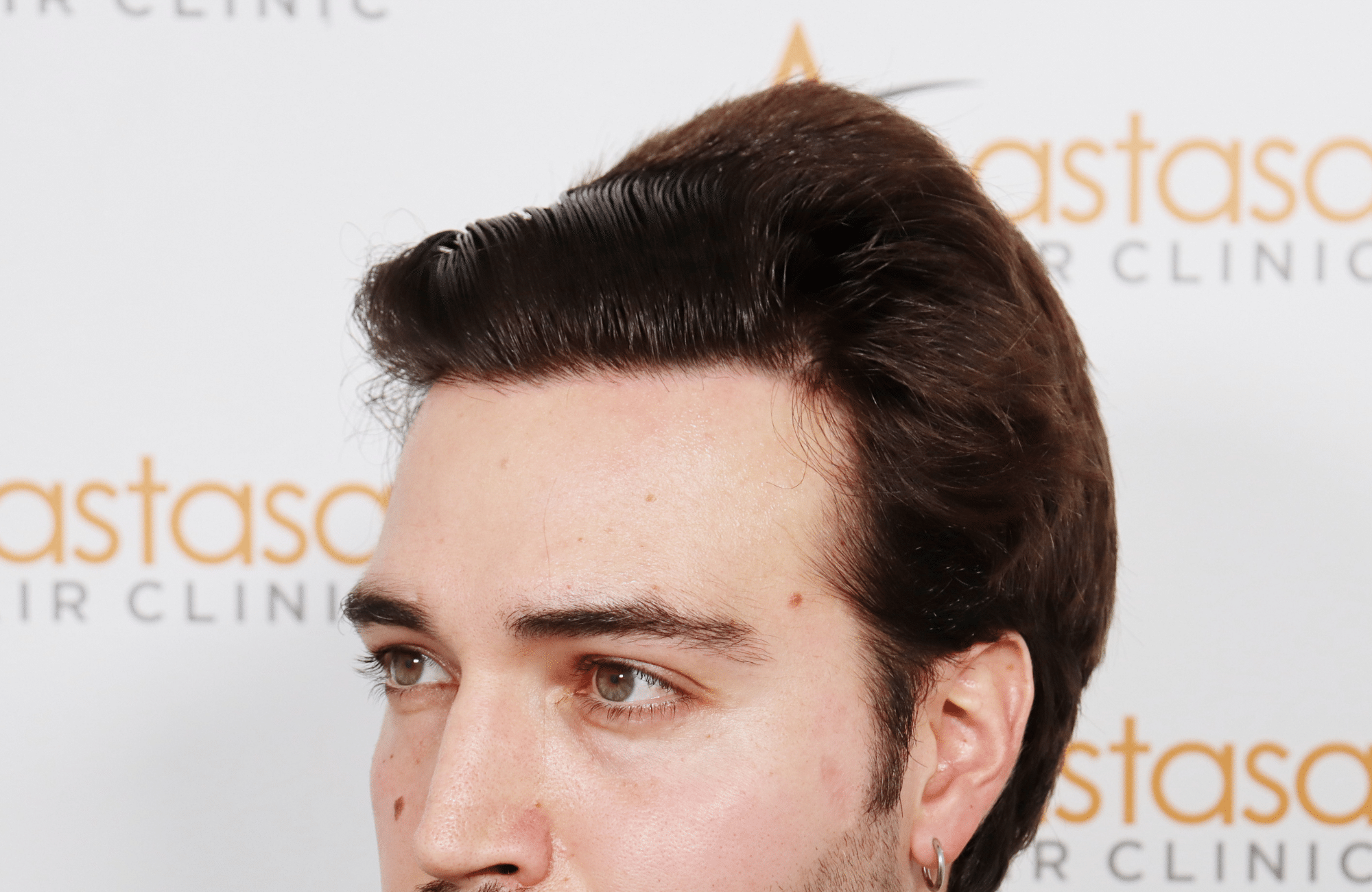 hair transplant result