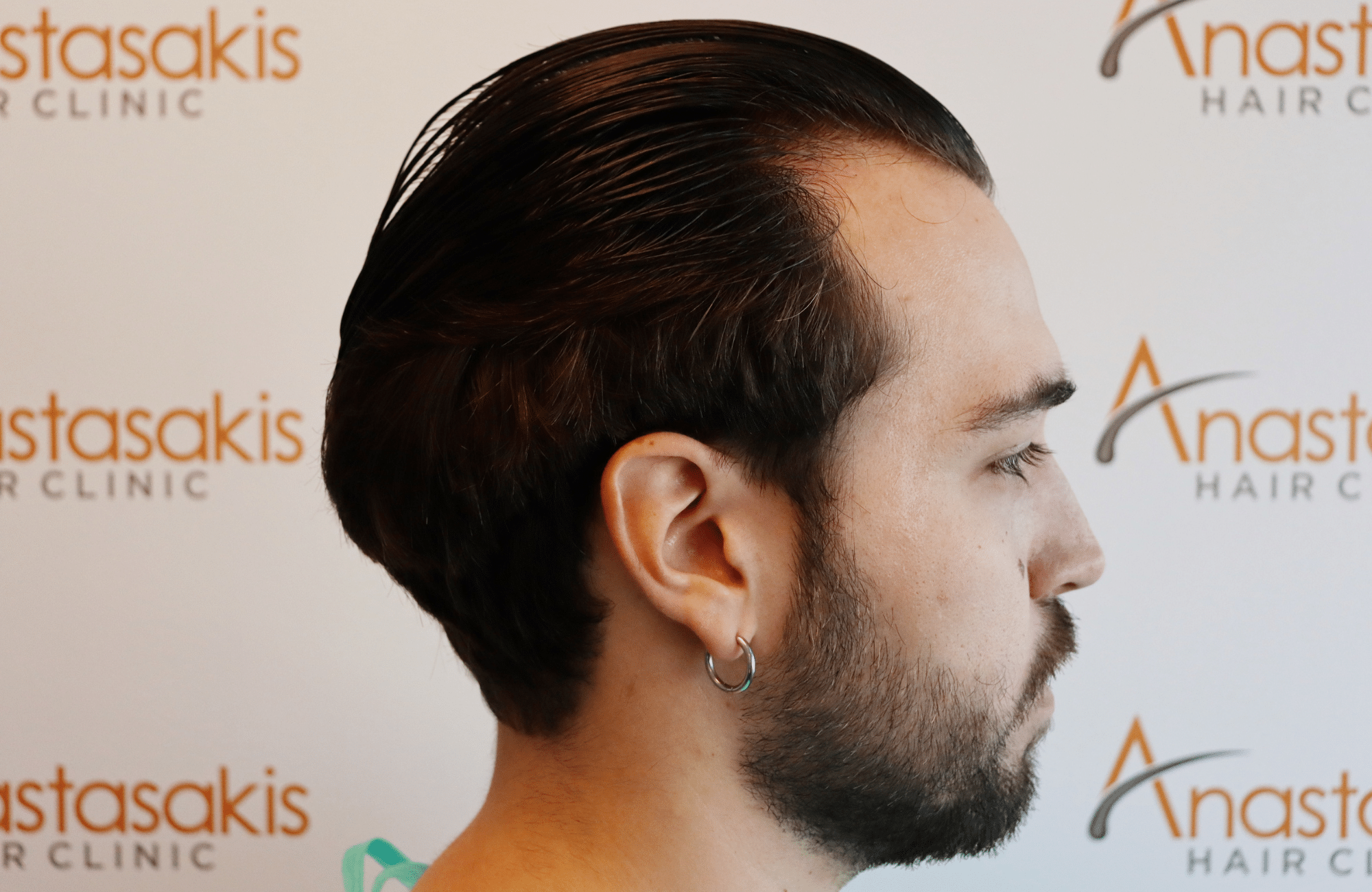 hair transplant result