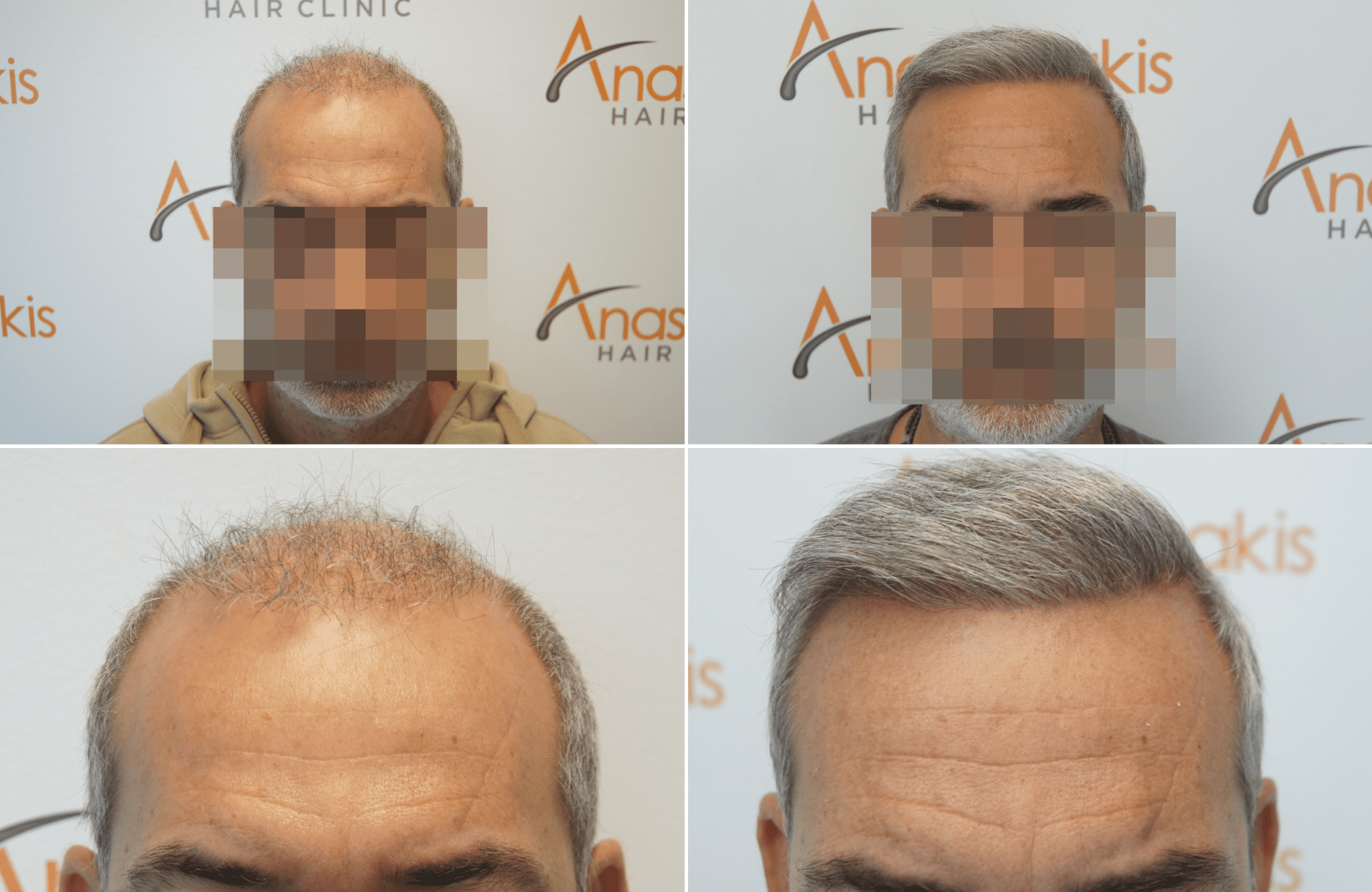 https://www.anastasakishairclinic.gr/portfolio/apotelesma-metamosxefsis-mallion-anastasakis-hair-clinic-402/