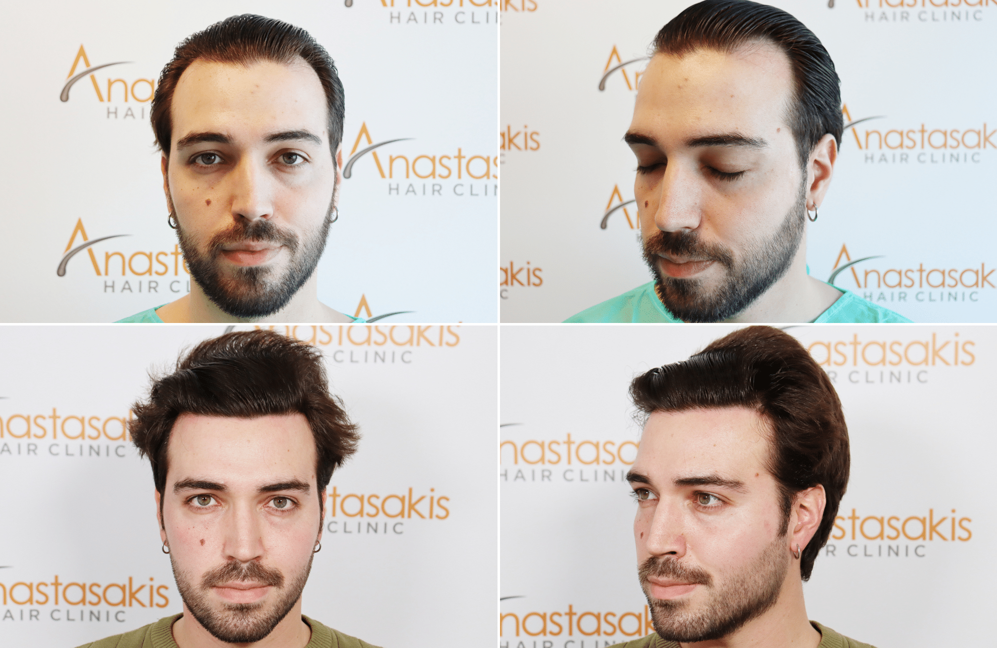 https://www.anastasakishairclinic.gr/portfolio/2500-fus-1-year-result-with-fue/