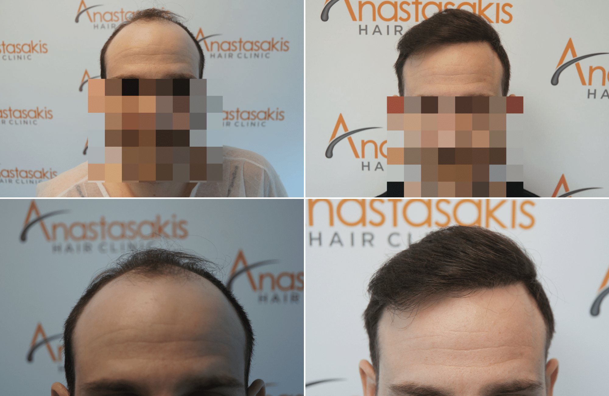 https://www.anastasakishairclinic.gr/portfolio/apotelesma-metamosxefsis-mallion-anastasakis-hair-clinic-210/