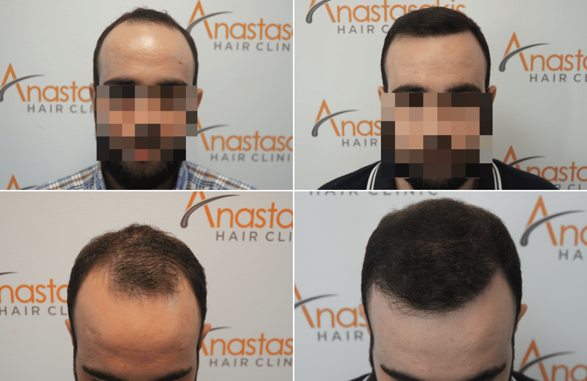 https://www.anastasakishairclinic.gr/portfolio/apotelesma-metamosxefsis-mallion-anastasakis-hair-clinic-383/