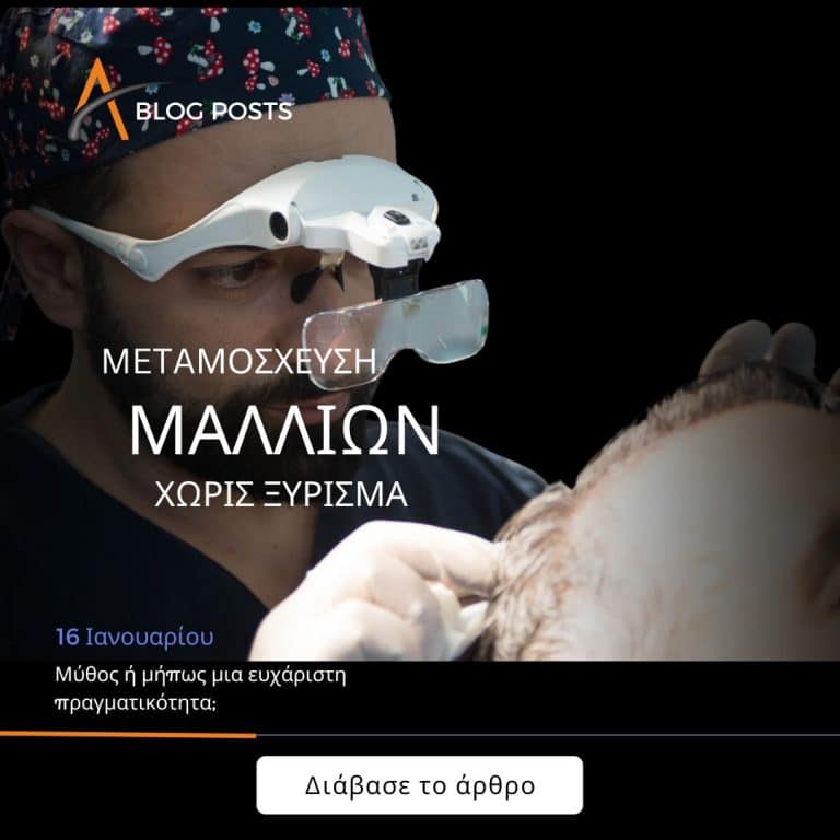 Μεταμόσχευση μαλλιών χωρίς ξύρισμα: Μύθος ή μήπως μια ευχάριστη πραγματικότητα;