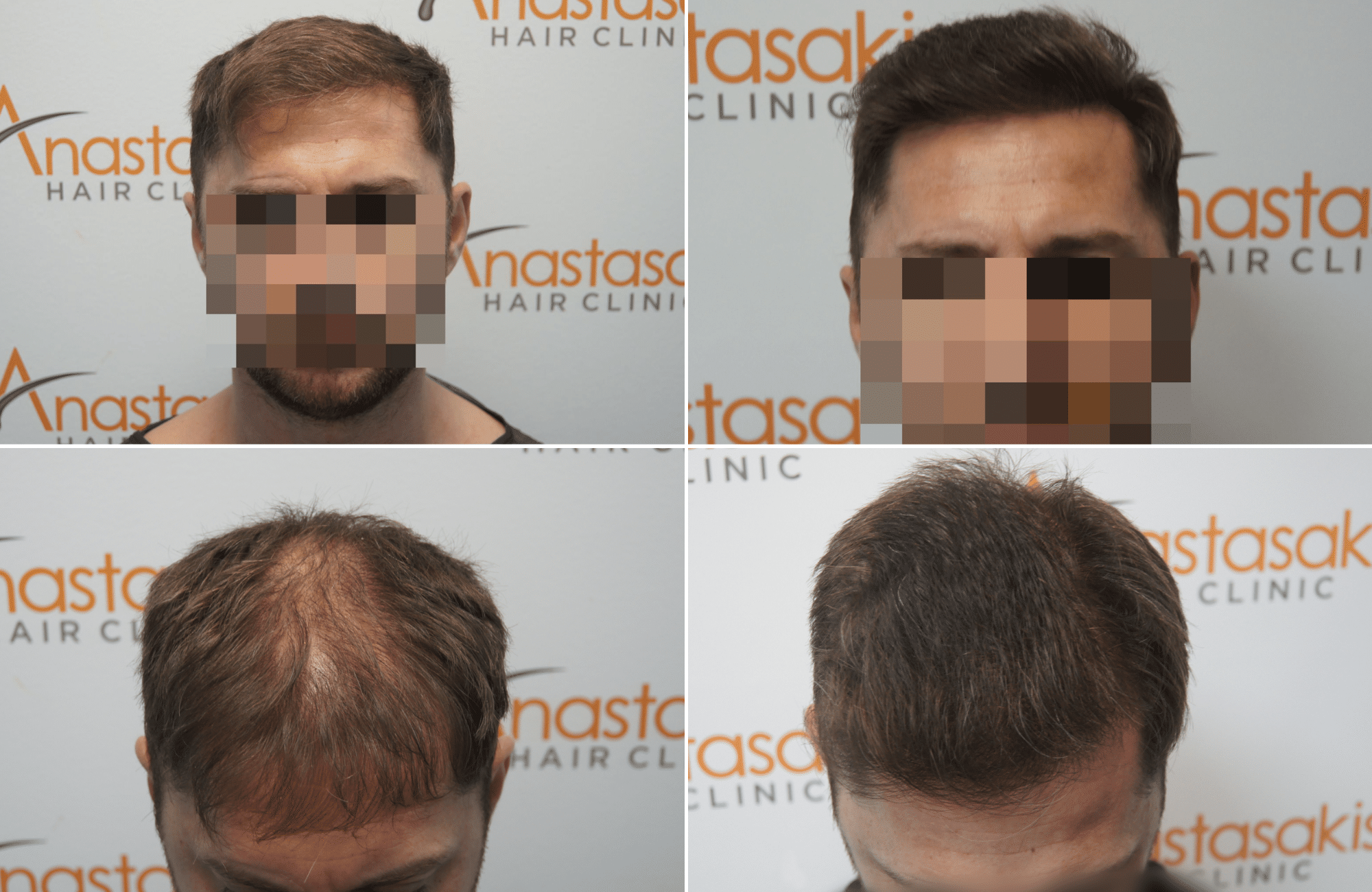 https://www.anastasakishairclinic.gr/portfolio/apotelesma-metamosxefsis-mallion-anastasakis-hair-clinic-365/