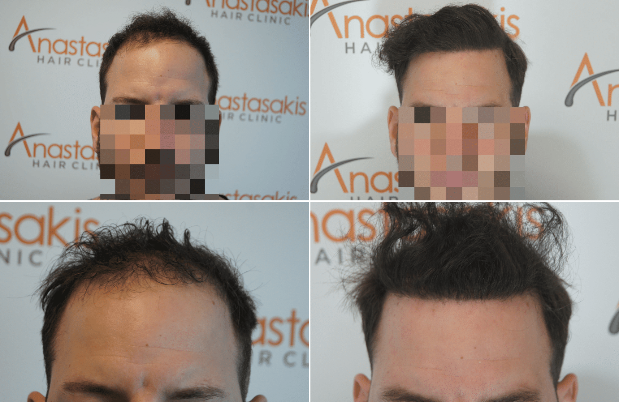 https://www.anastasakishairclinic.gr/portfolio/apotelesma-metamosxefsis-mallion-anastasakis-hair-clinic-366/