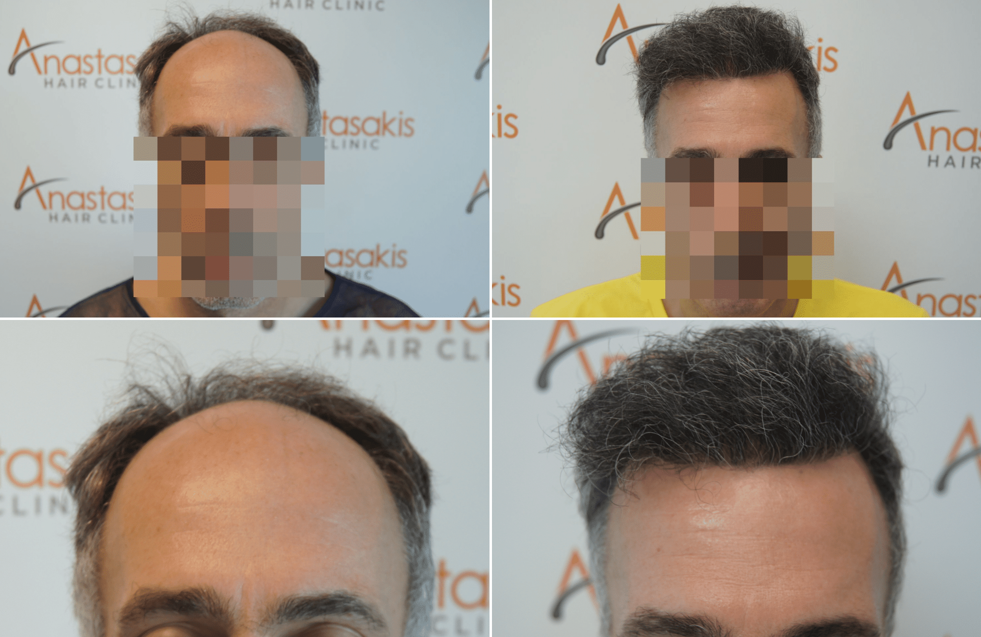 https://www.anastasakishairclinic.gr/portfolio/apotelesma-metamosxefsis-mallion-anastasakis-hair-clinic-163/