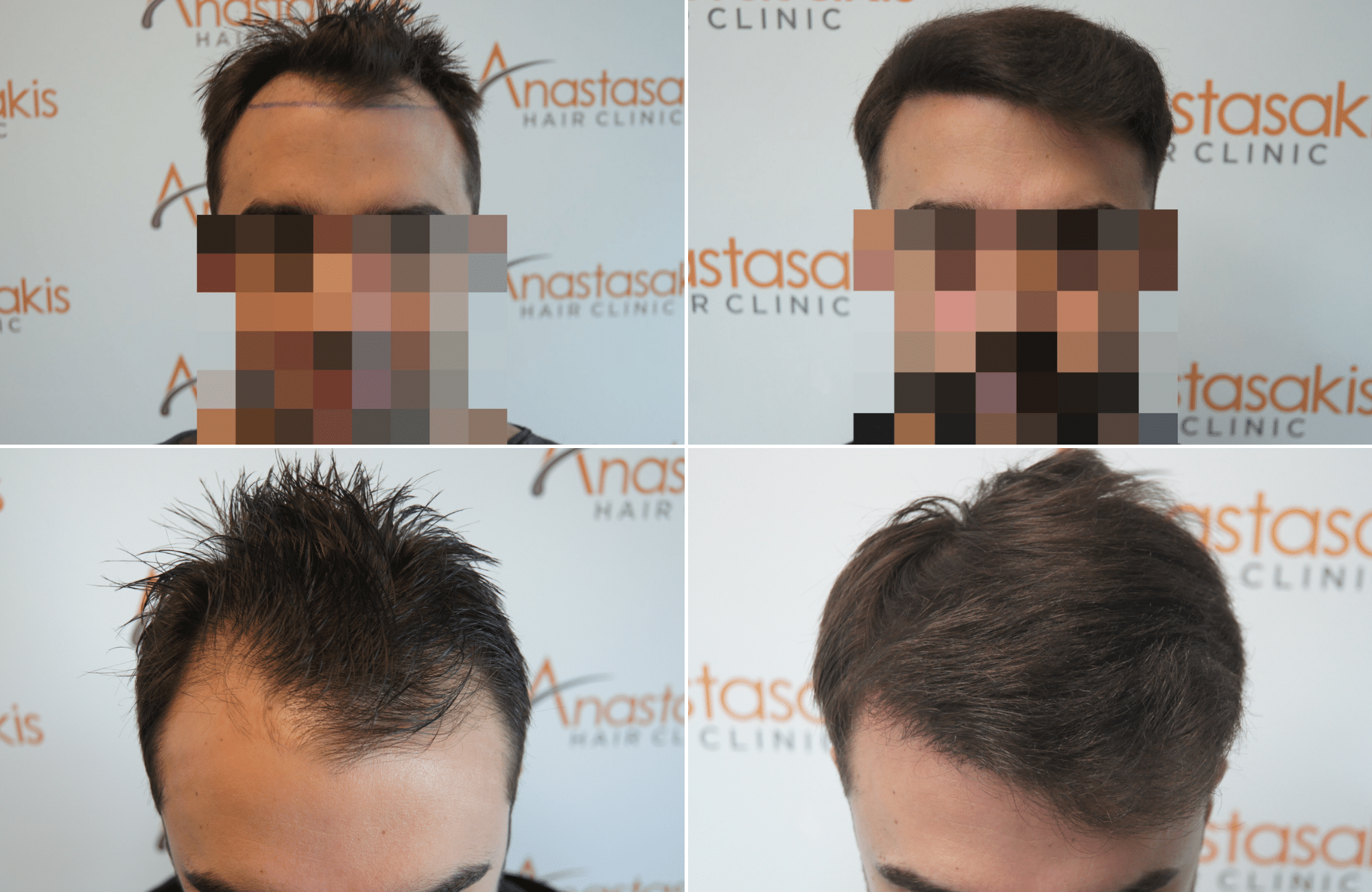 https://www.anastasakishairclinic.gr/portfolio/apotelesma-metamosxefsis-mallion-anastasakis-hair-clinic-214/