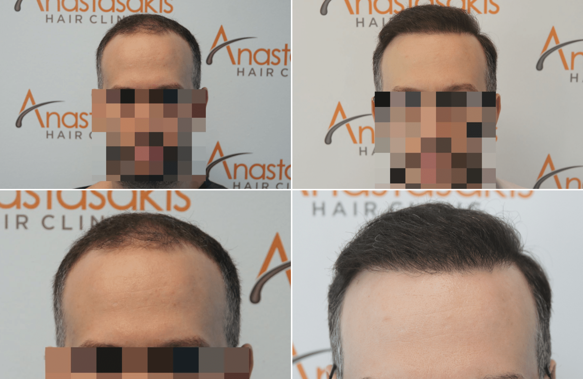 https://www.anastasakishairclinic.gr/portfolio/apotelesma-metamosxefsis-mallion-anastasakis-hair-clinic-367/