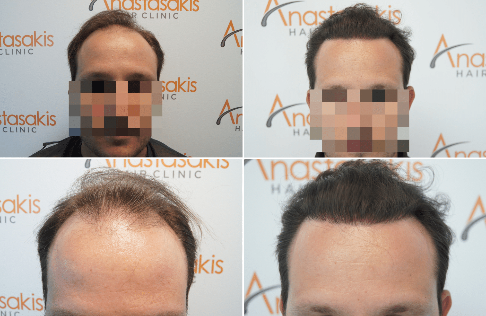 https://www.anastasakishairclinic.gr/portfolio/apotelesma-metamosxefsis-mallion-anastasakis-hair-clinic-370/