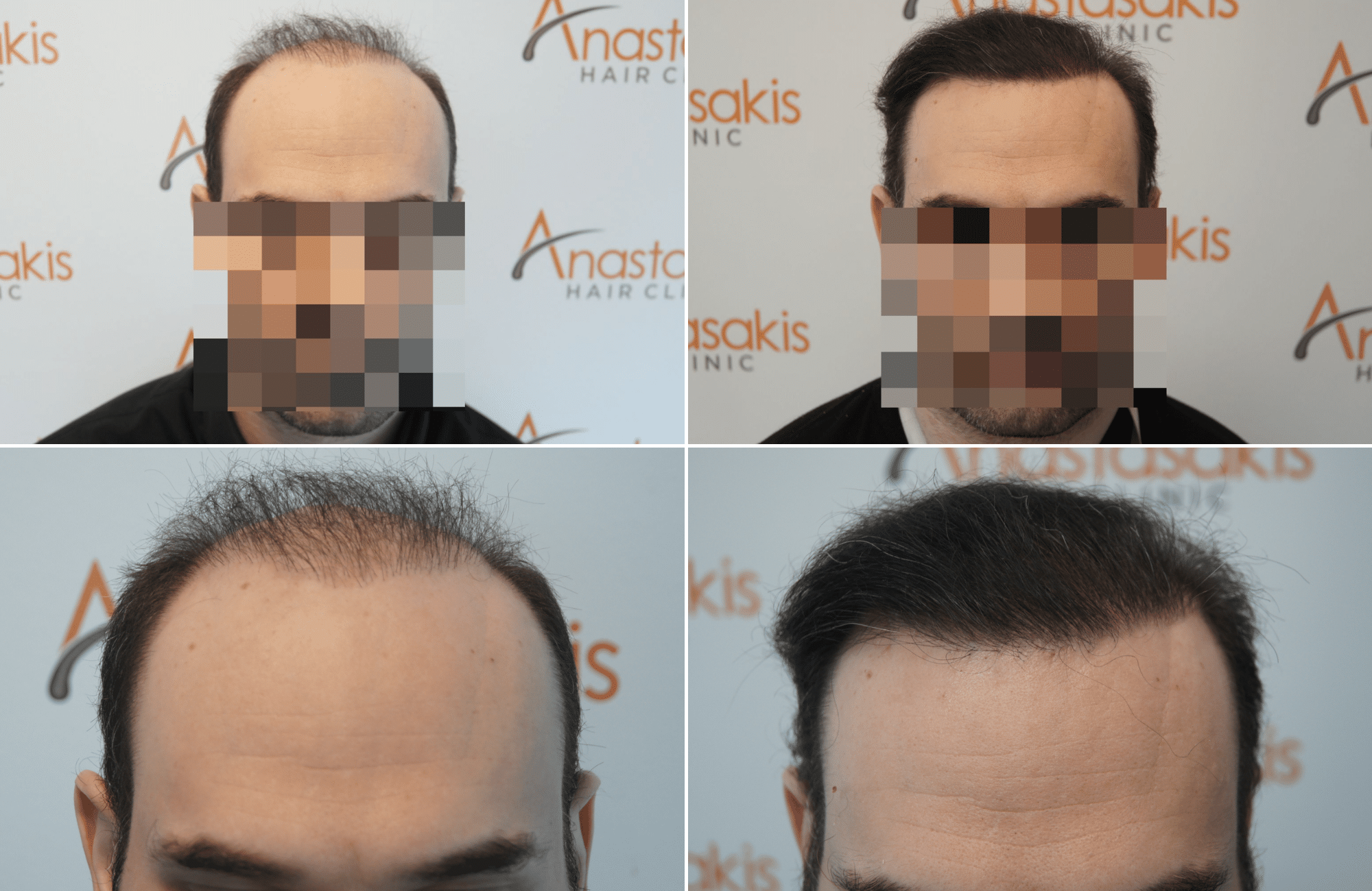 https://www.anastasakishairclinic.gr/portfolio/apotelesma-metamosxefsis-mallion-anastasakis-hair-clinic-371/