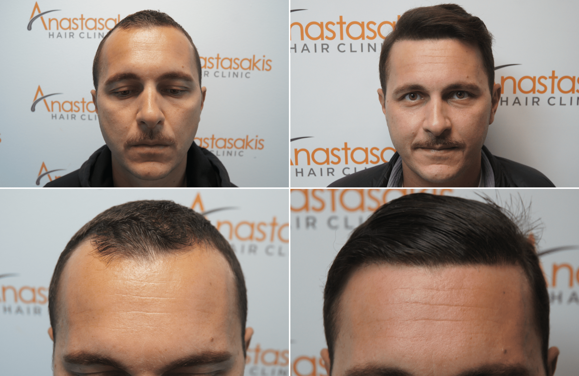 https://www.anastasakishairclinic.gr/portfolio/apotelesma-metamosxefsis-mallion-anastasakis-hair-clinic-220/