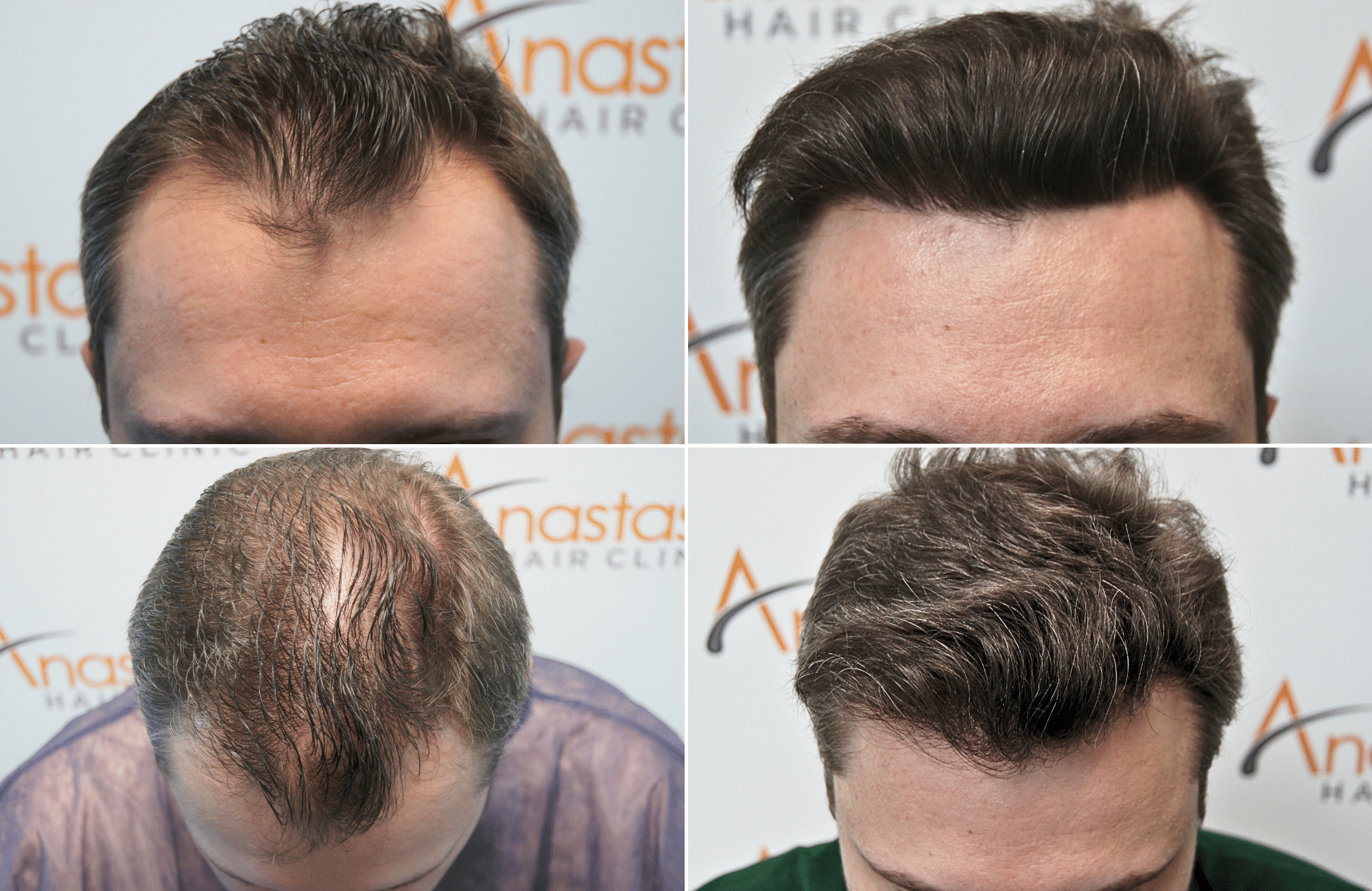 https://www.anastasakishairclinic.gr/portfolio/apotelesma-metamosxefsis-mallion-anastasakis-hair-clinic-13/