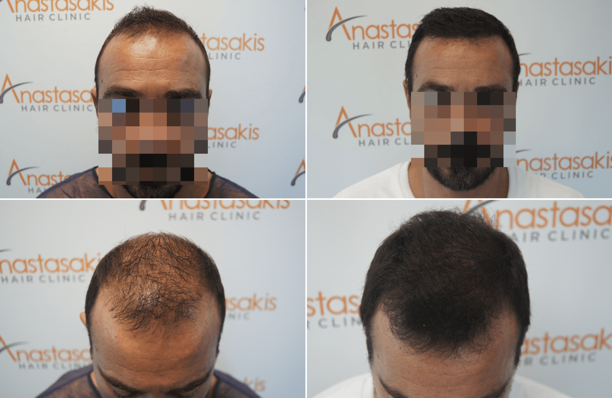 https://www.anastasakishairclinic.gr/portfolio/apotelesma-metamosxefsis-mallion-anastasakis-hair-clinic-368/