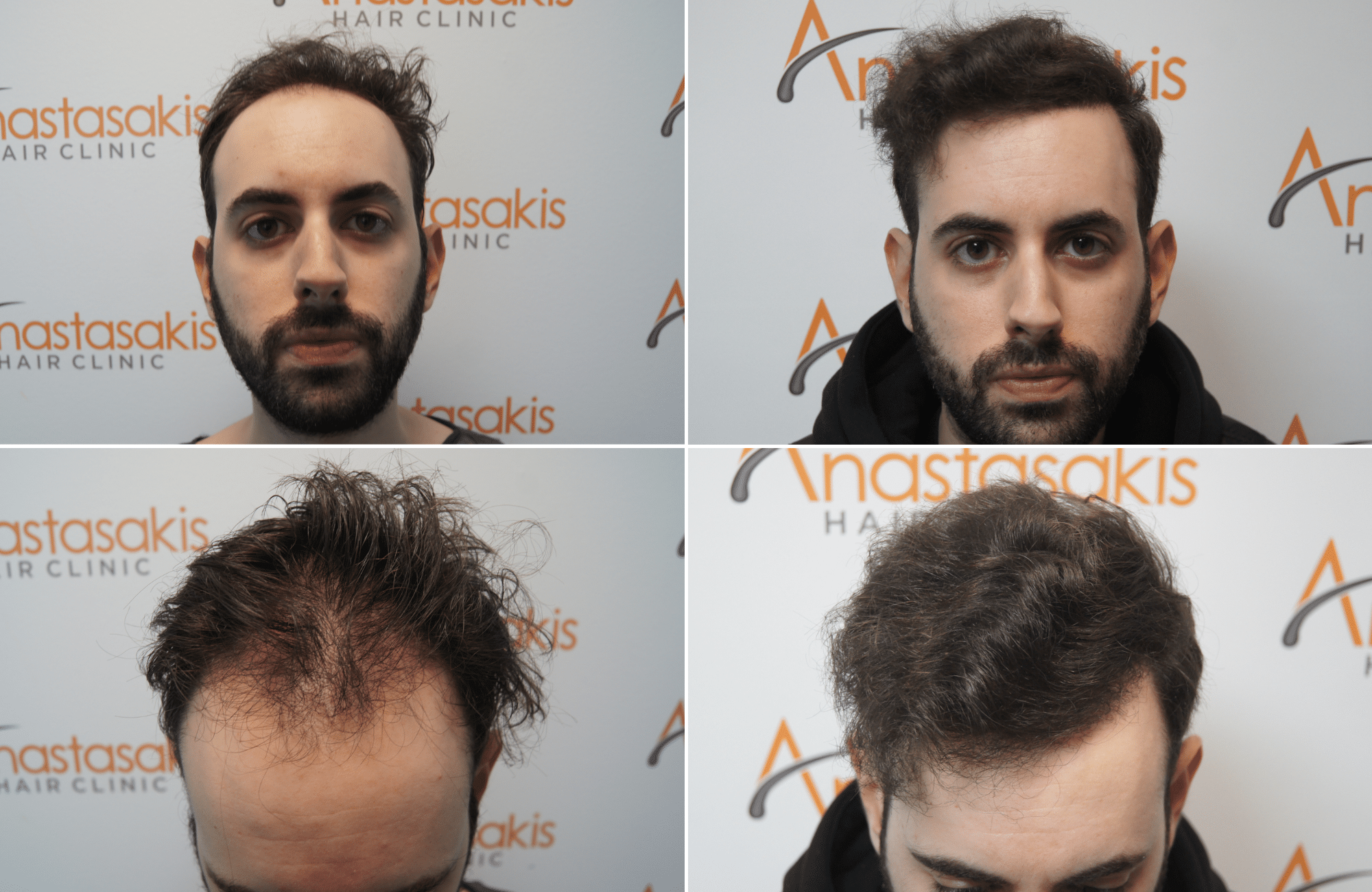 https://www.anastasakishairclinic.gr/portfolio/apotelesma-metamosxefsis-mallion-anastasakis-hair-clinic-229/