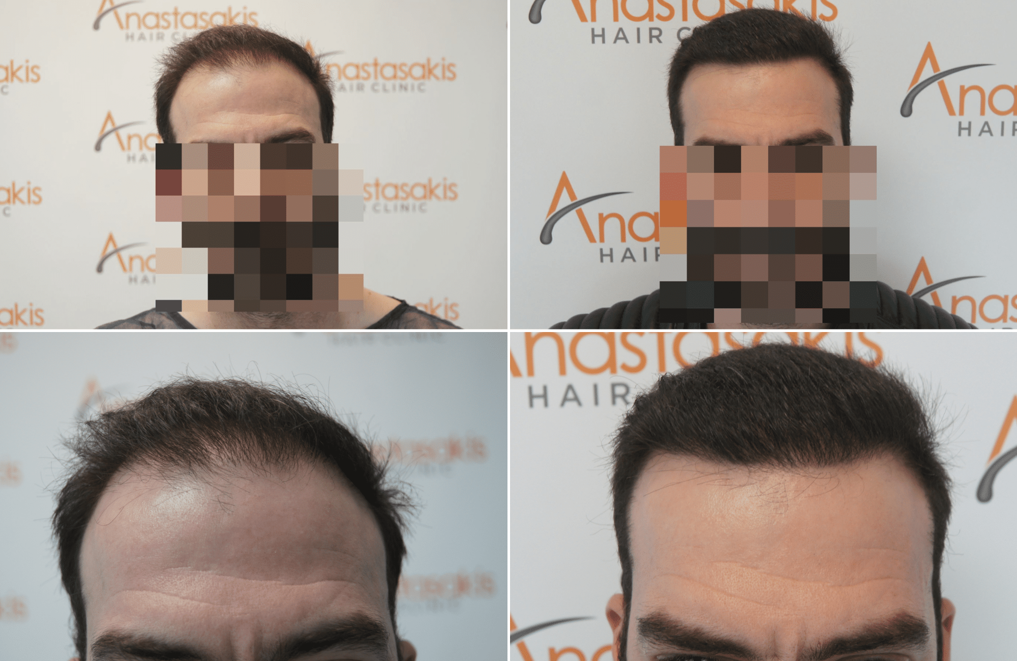 https://www.anastasakishairclinic.gr/portfolio/apotelesma-metamosxefsis-mallion-anastasakis-hair-clinic-226/