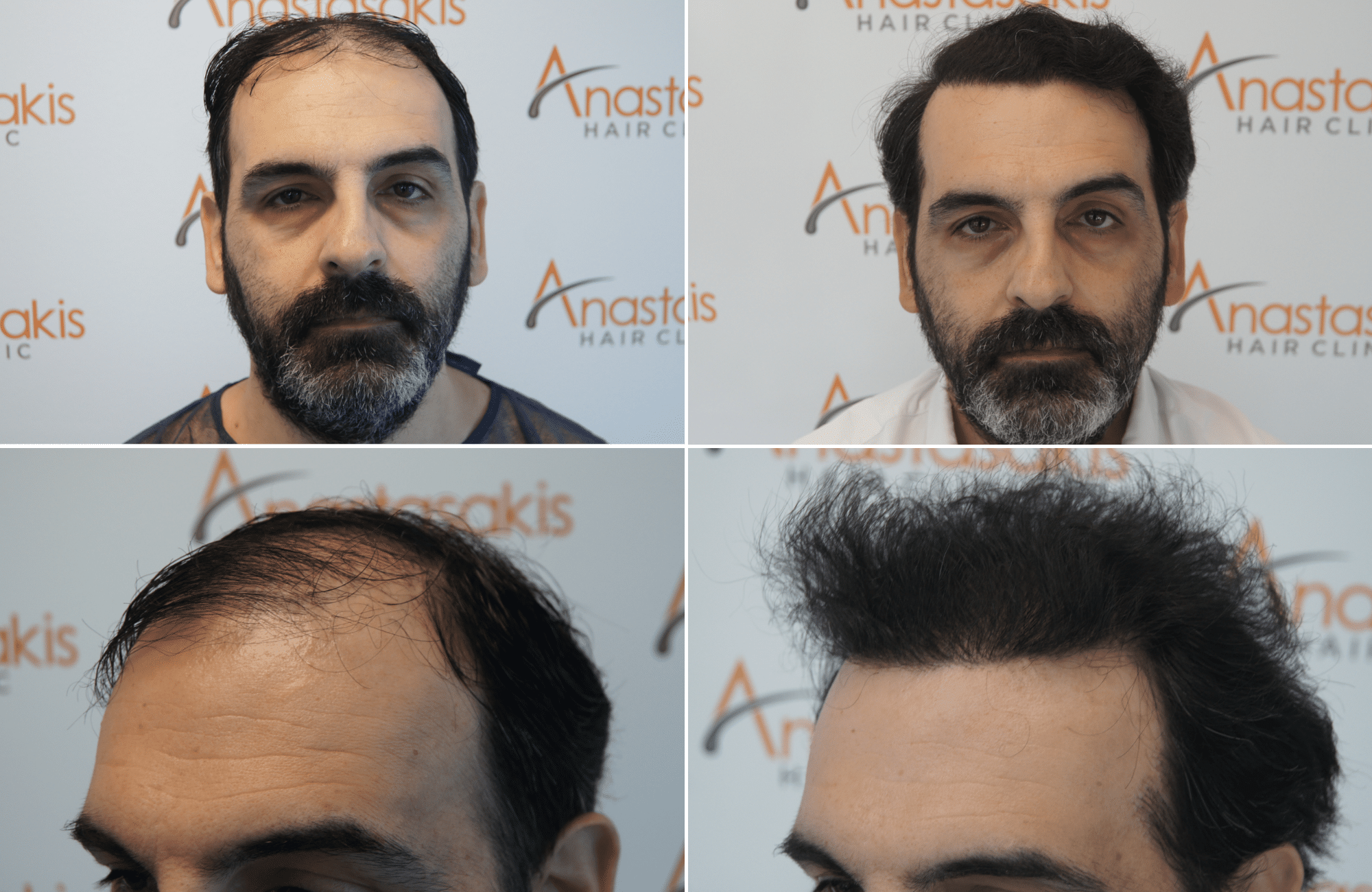 https://www.anastasakishairclinic.gr/portfolio/apotelesma-metamosxefsis-mallion-anastasakis-hair-clinic-161/