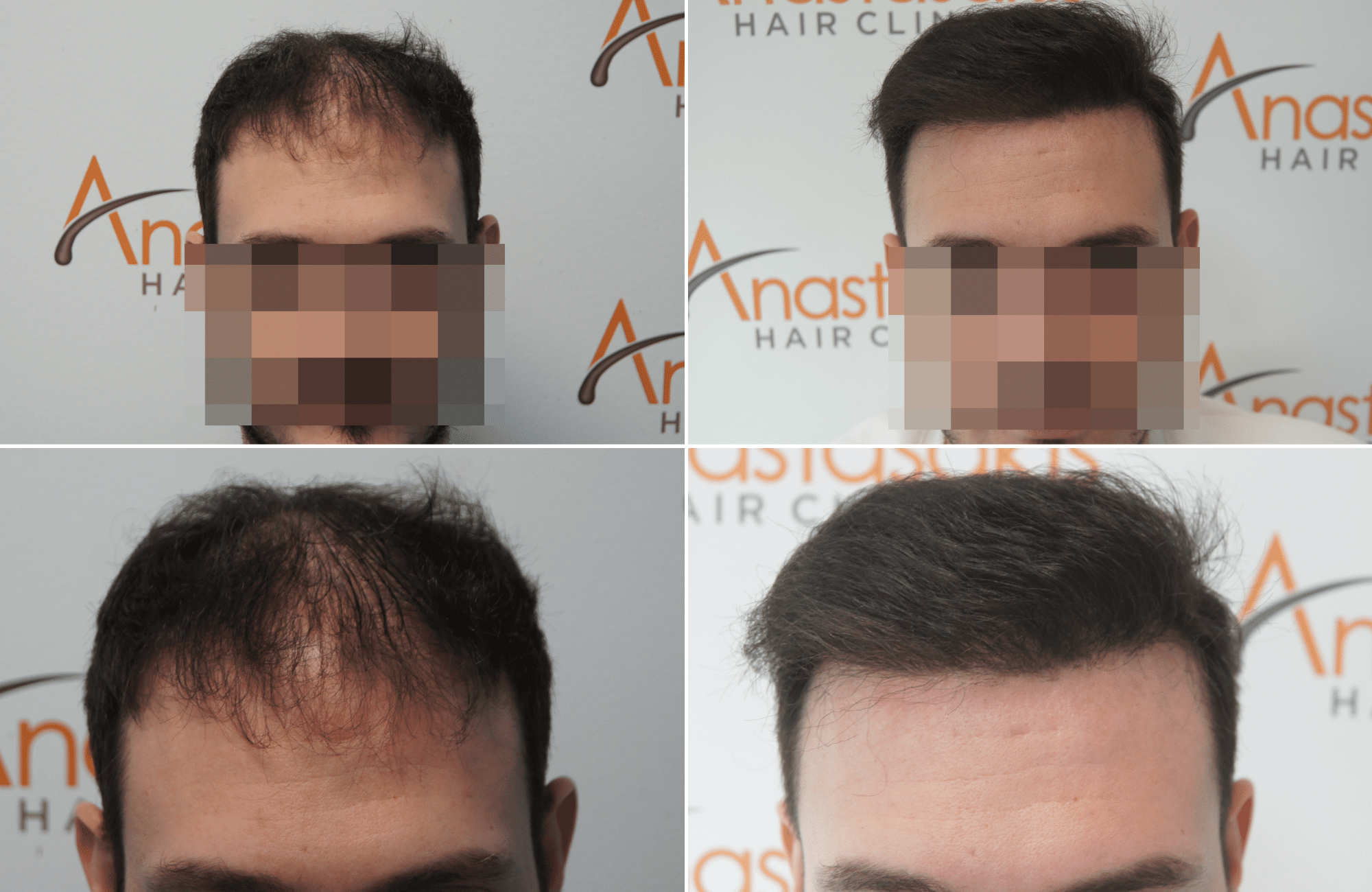 https://www.anastasakishairclinic.gr/portfolio/apotelesma-metamosxefsis-mallion-anastasakis-hair-clinic-238/