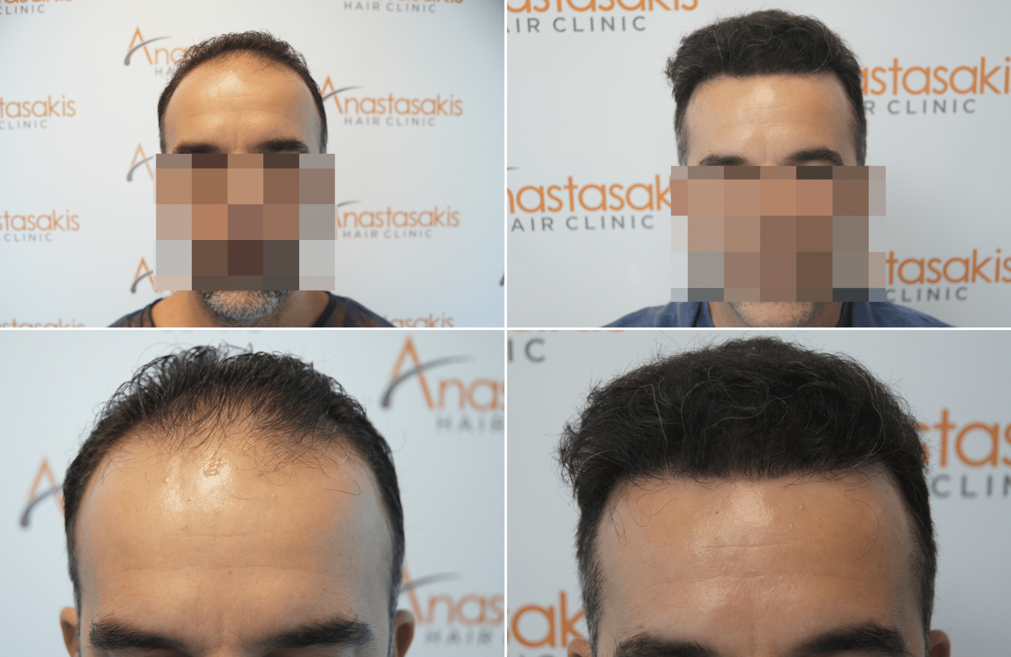 https://www.anastasakishairclinic.gr/portfolio/apotelesma-metamosxefsis-mallion-anastasakis-hair-clinic-241/