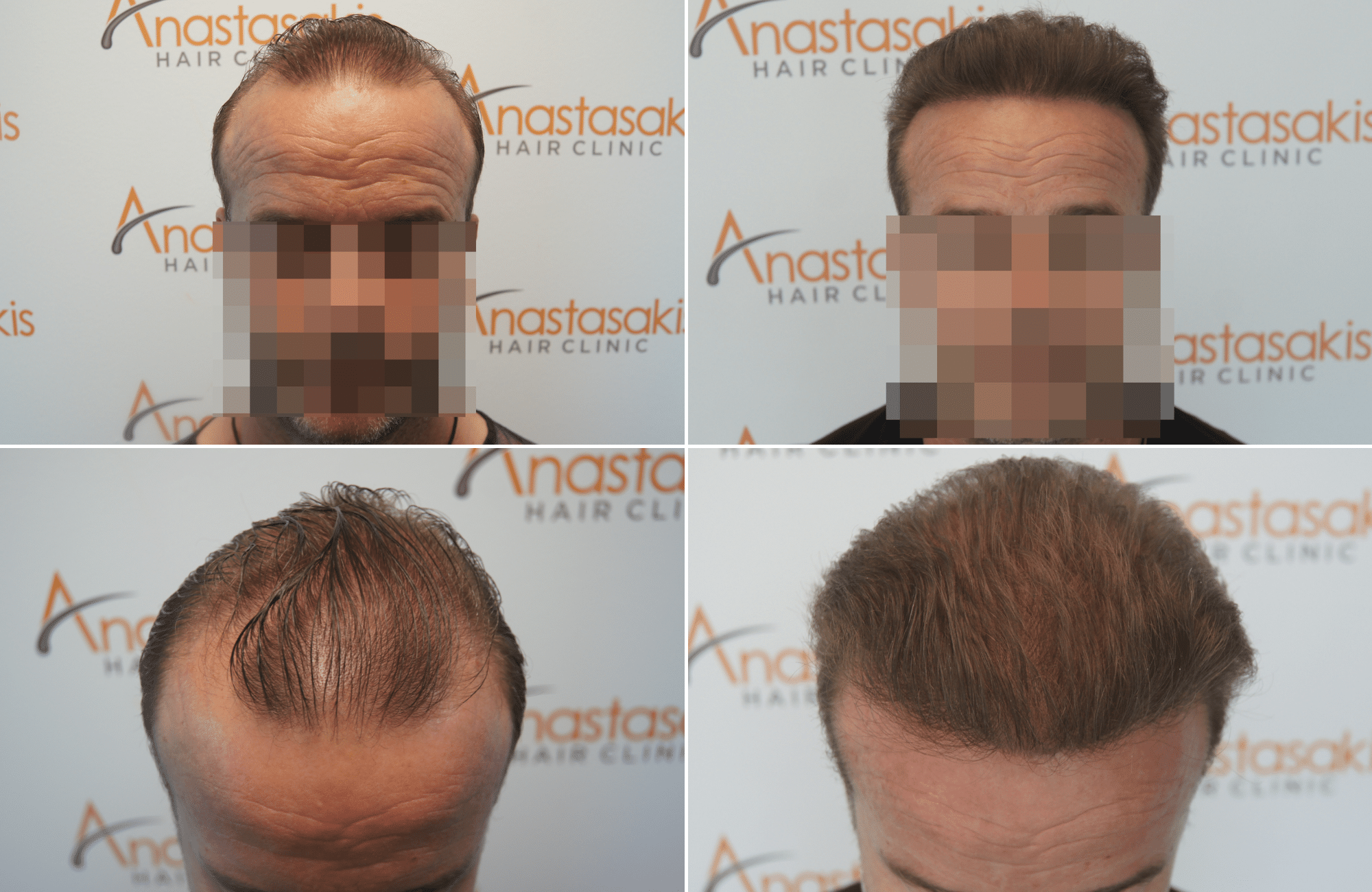 https://www.anastasakishairclinic.gr/portfolio/apotelesma-metamosxefsis-mallion-anastasakis-hair-clinic-256/