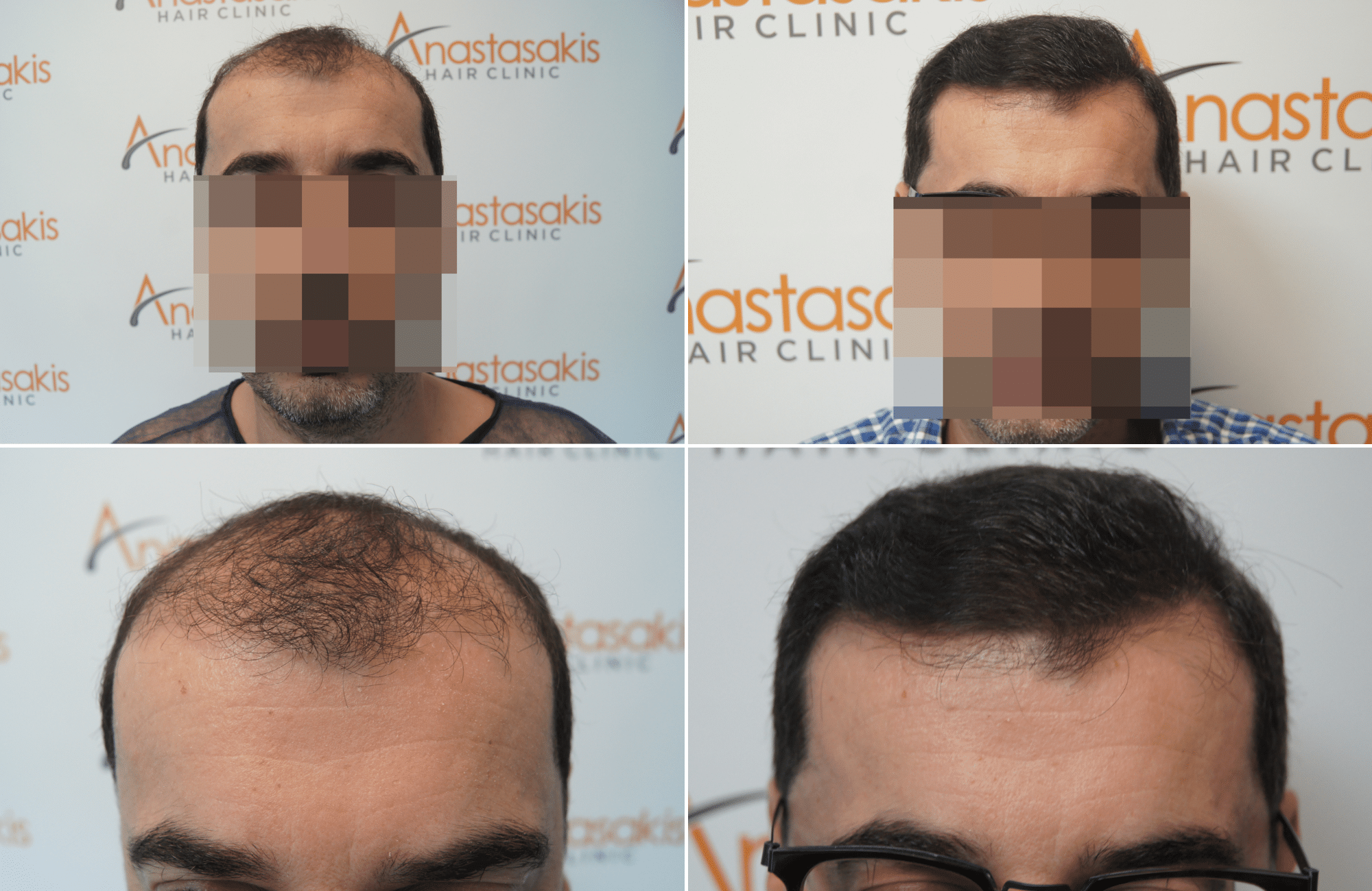 https://www.anastasakishairclinic.gr/portfolio/apotelesma-metamosxefsis-mallion-anastasakis-hair-clinic-333/