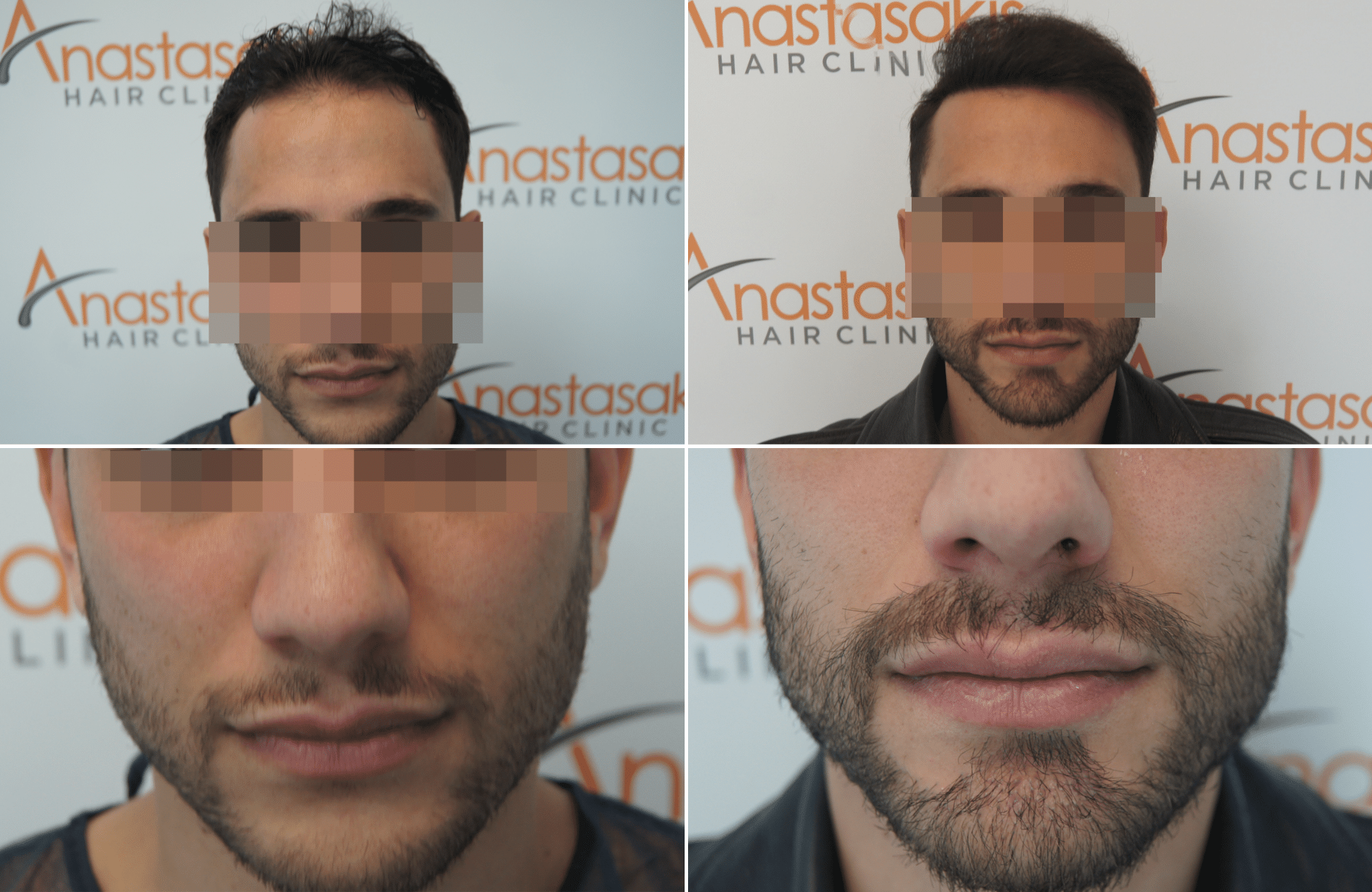 https://www.anastasakishairclinic.gr/portfolio/apotelesma-metamosxefsis-mallion-anastasakis-hair-clinic-372/