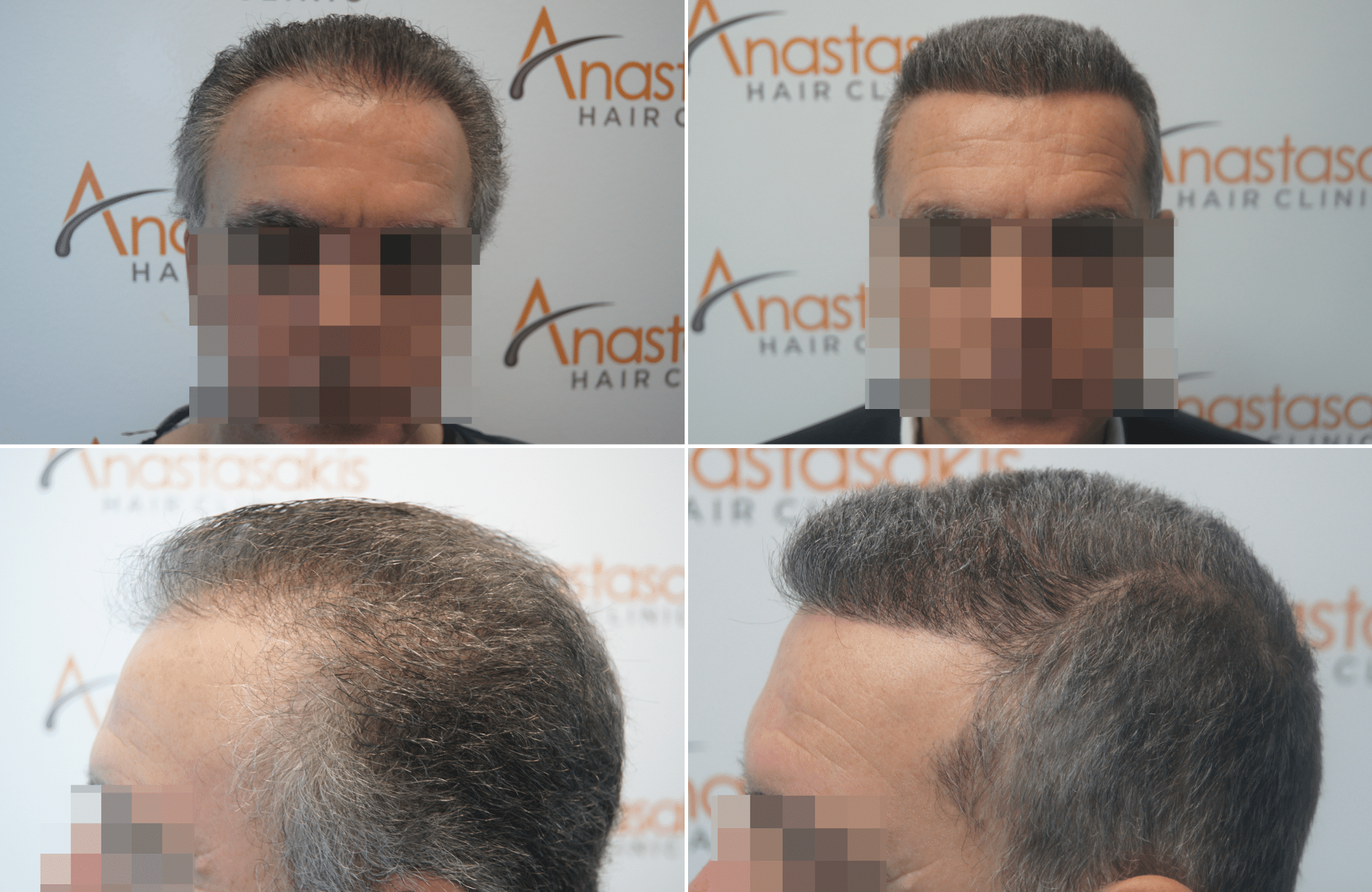 https://www.anastasakishairclinic.gr/portfolio/apotelesma-metamosxefsis-mallion-anastasakis-hair-clinic-373/