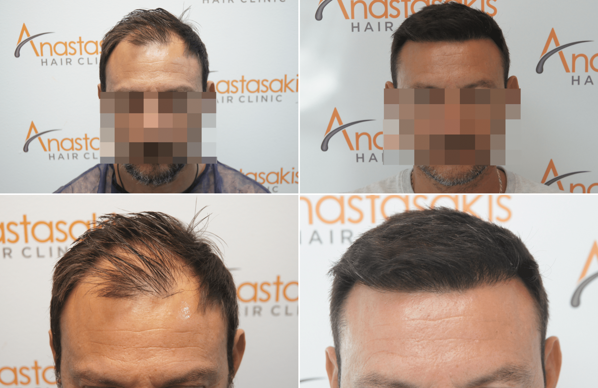 https://www.anastasakishairclinic.gr/portfolio/apotelesma-metamosxefsis-mallion-anastasakis-hair-clinic-374/