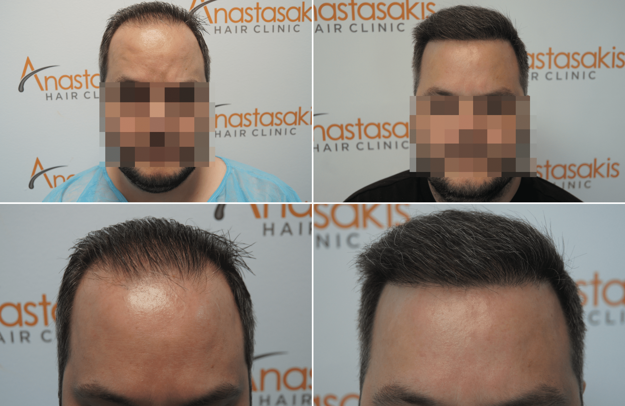 https://www.anastasakishairclinic.gr/portfolio/apotelesma-metamosxefsis-mallion-anastasakis-hair-clinic-375/